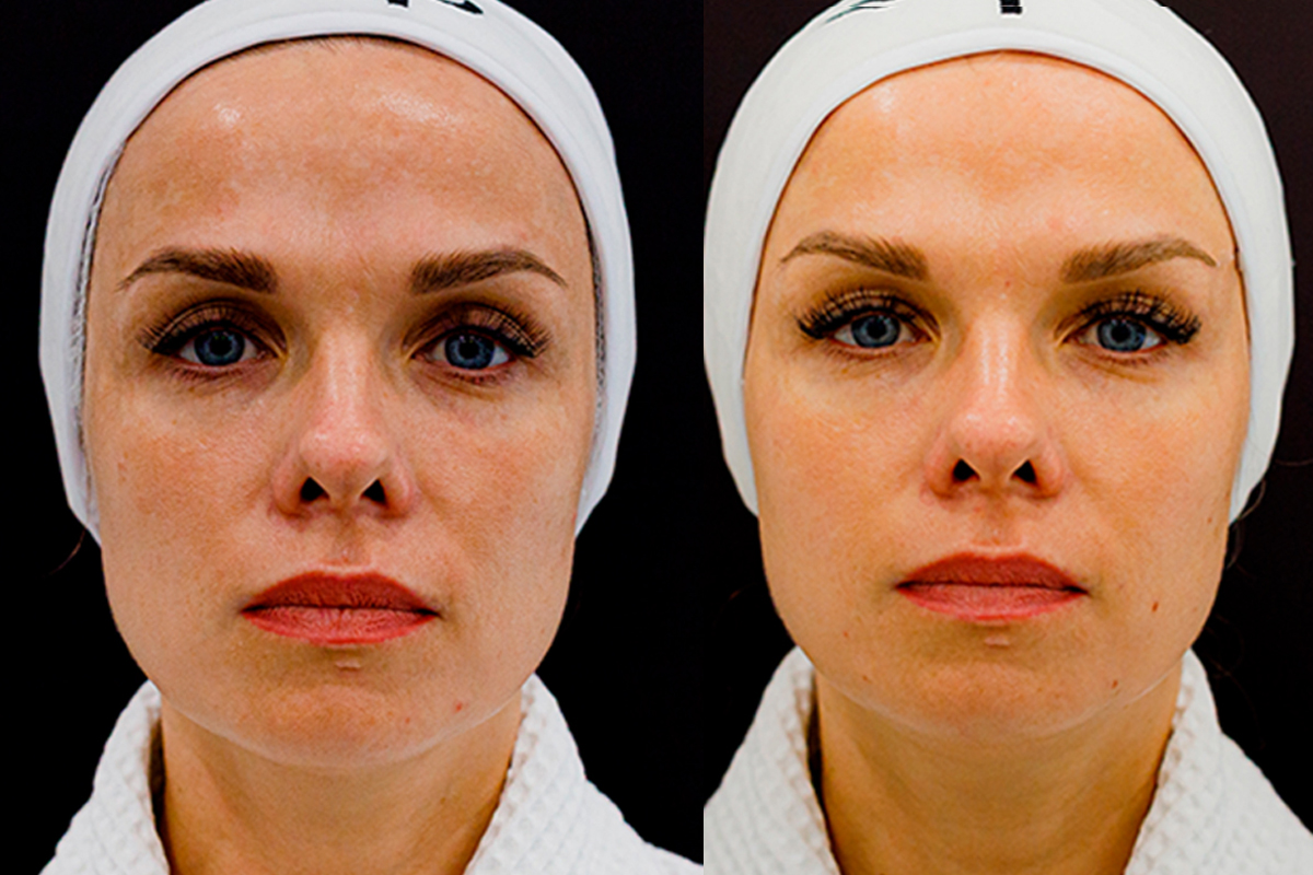 Лазерное омоложение лица, глаз пикосекундным лазером Picosure - VIP Clinic.  Цены на процедуры пикосекундного лазера, стоимость в Москве