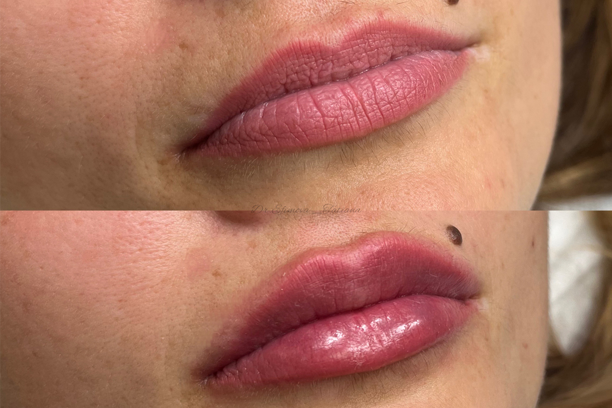 Филлеры Ювидерм (Juvederm) 01