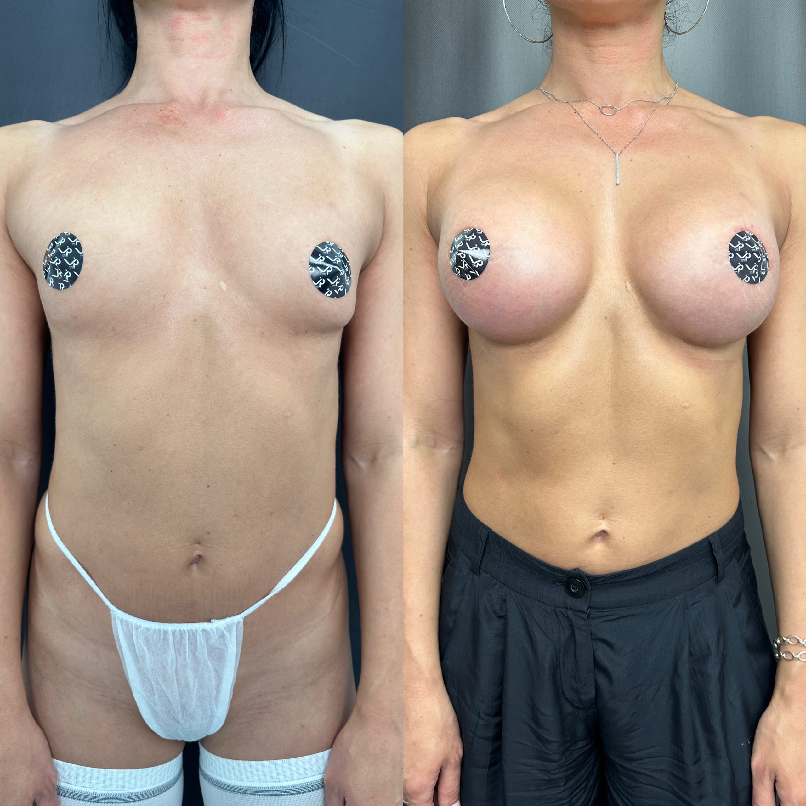 Увеличение груди имплантами 01