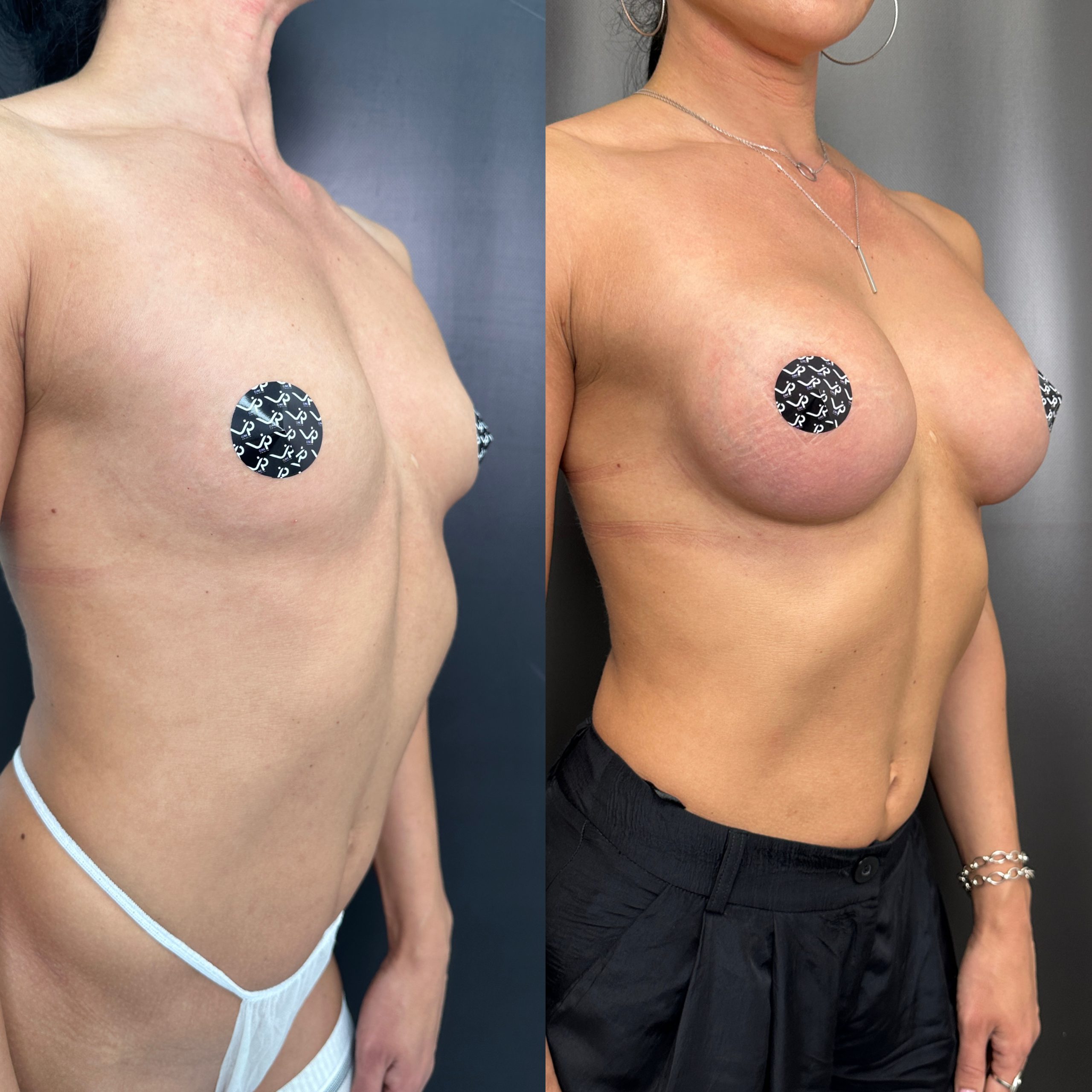 Увеличение груди имплантами 01