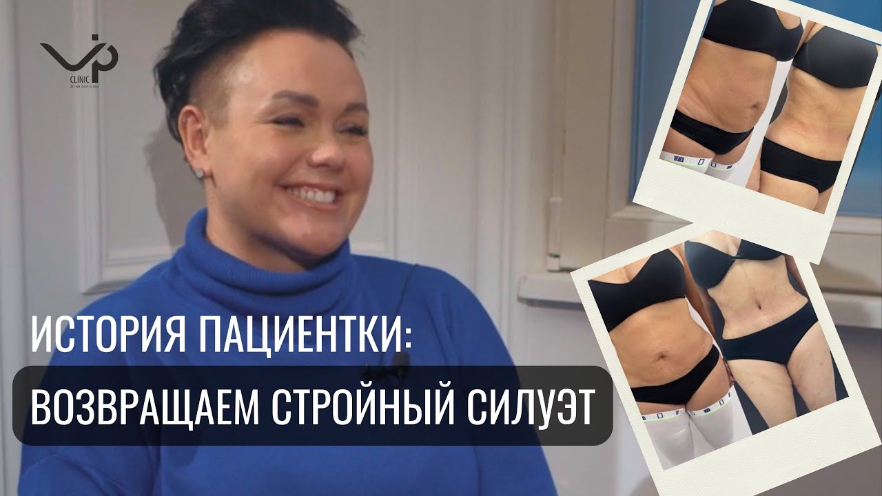 Выпуск 2 — Подтяжка живота (абдоминопластика). История пациента