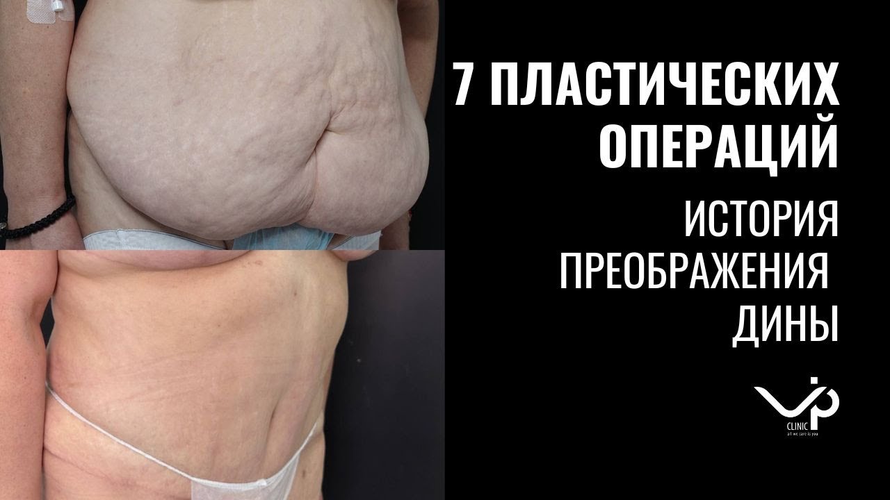 Выпуск 6 — 7 пластических операций. История пациента Дины