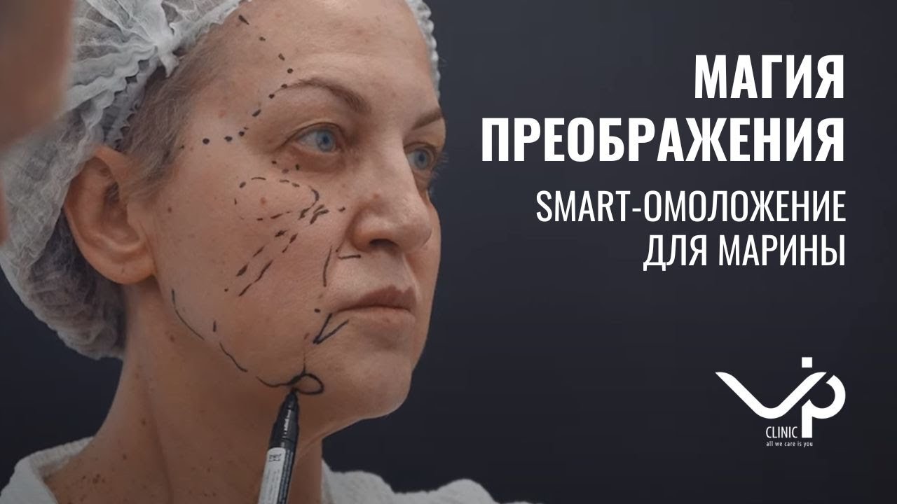 Выпуск 5 — SMART-омоложение лица. Что делать, если чувствуешь себя на 35, а в паспорте больше 50? История пациента Марины