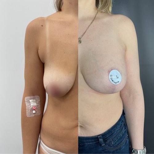 Уменьшение груди — редукционная маммопластика