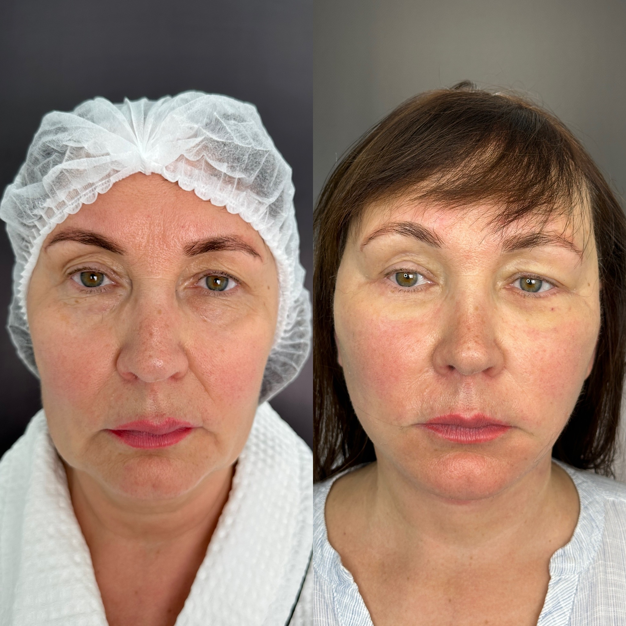 Выпуск 12 - «Оказывается, жизнь только начинается, у меня ещё всё впереди». История пациента Веры 01