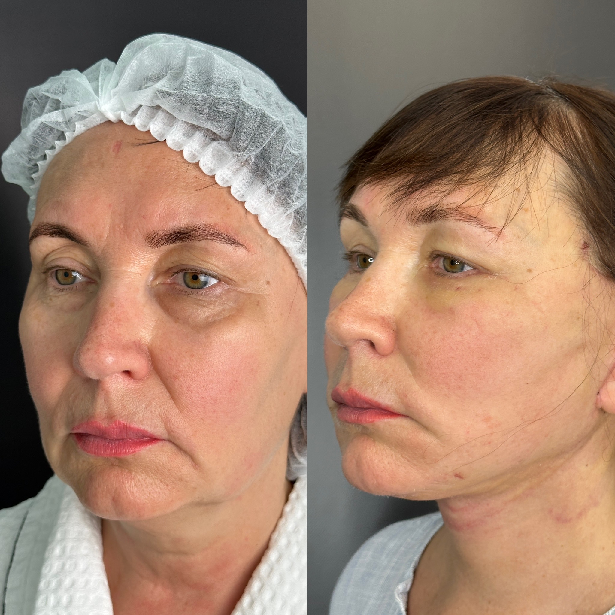 Выпуск 12 - «Оказывается, жизнь только начинается, у меня ещё всё впереди». История пациента Веры 02