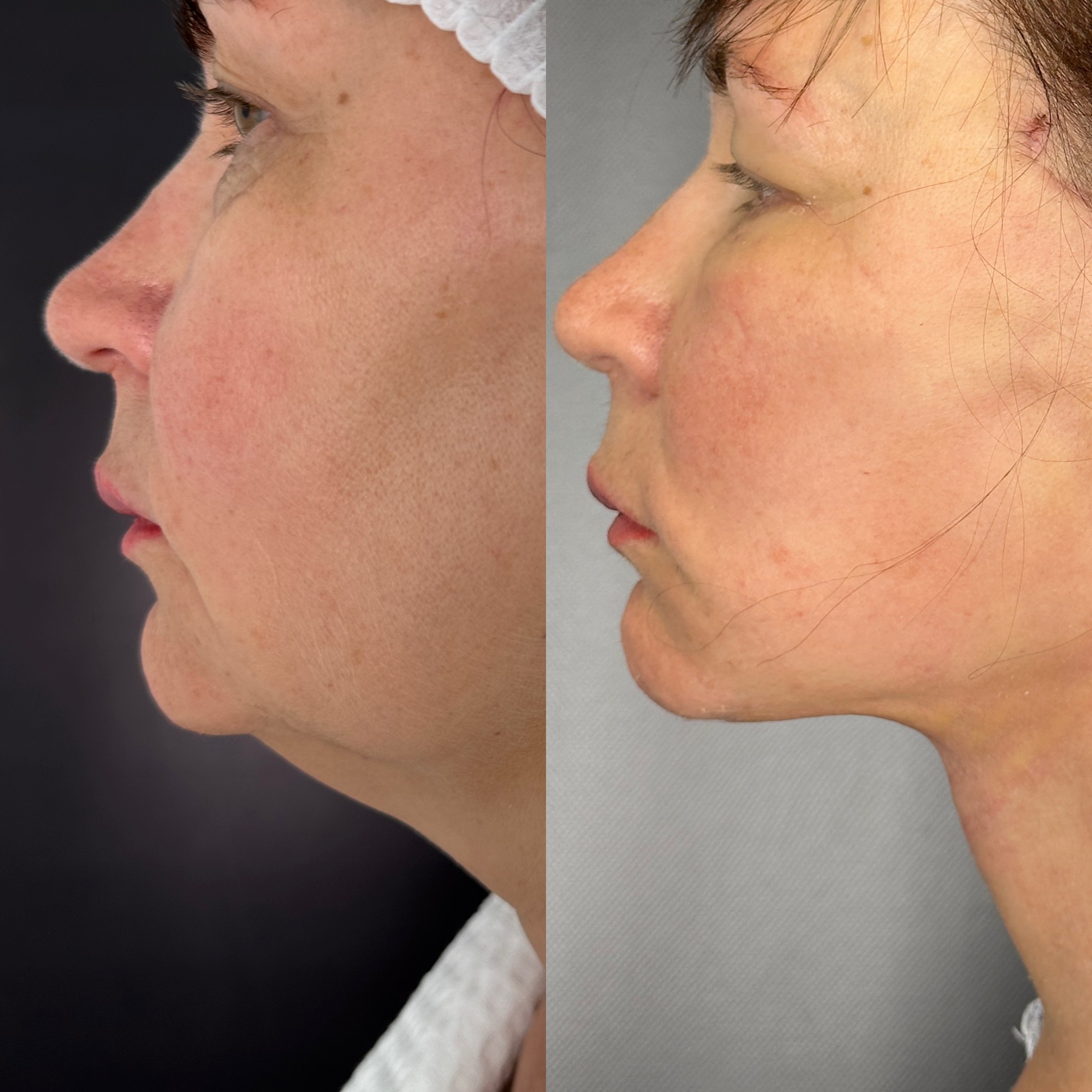 Выпуск 12 - «Оказывается, жизнь только начинается, у меня ещё всё впереди». История пациента Веры 03