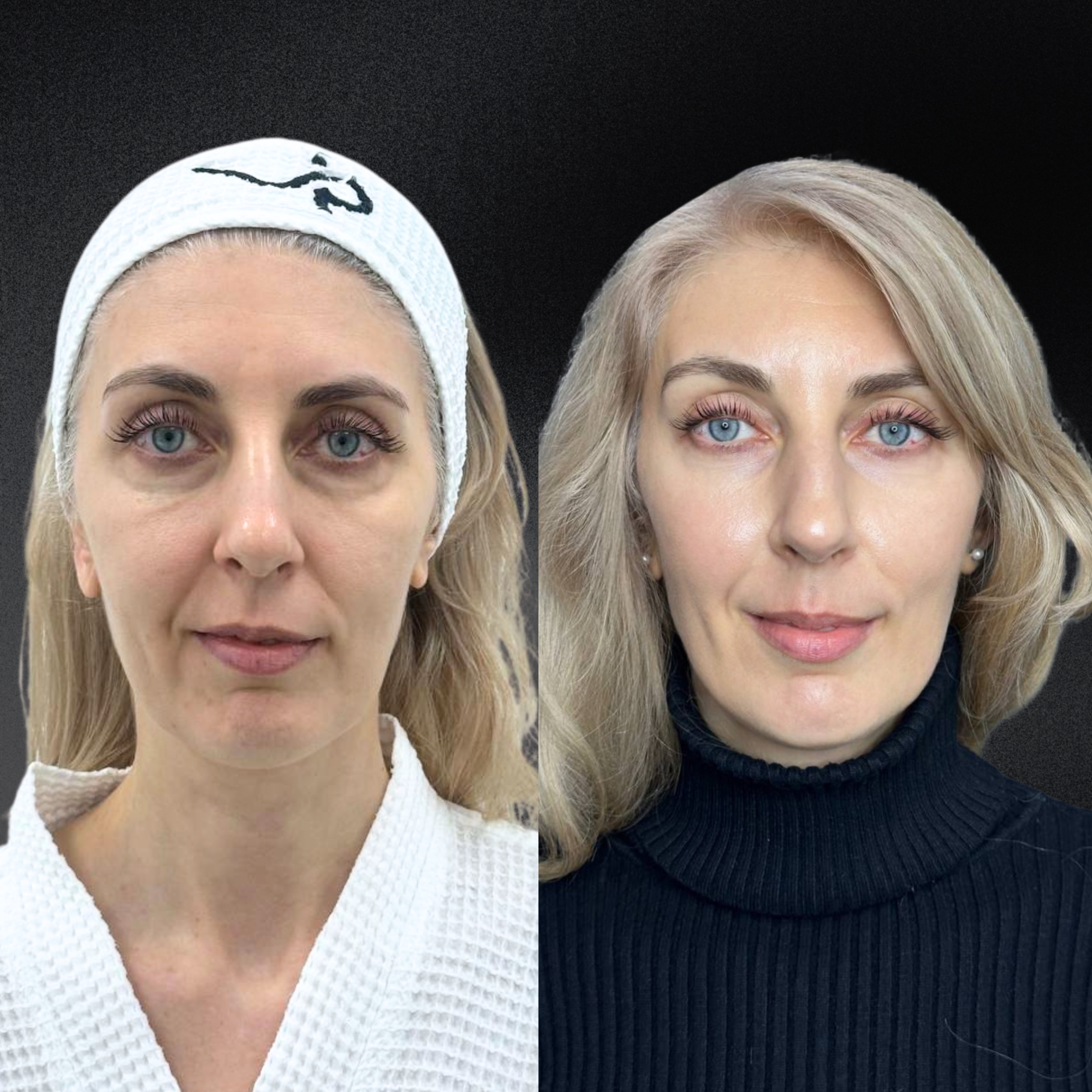 Омоложение кожи и лечение рубцов ALMA HYBRID 01