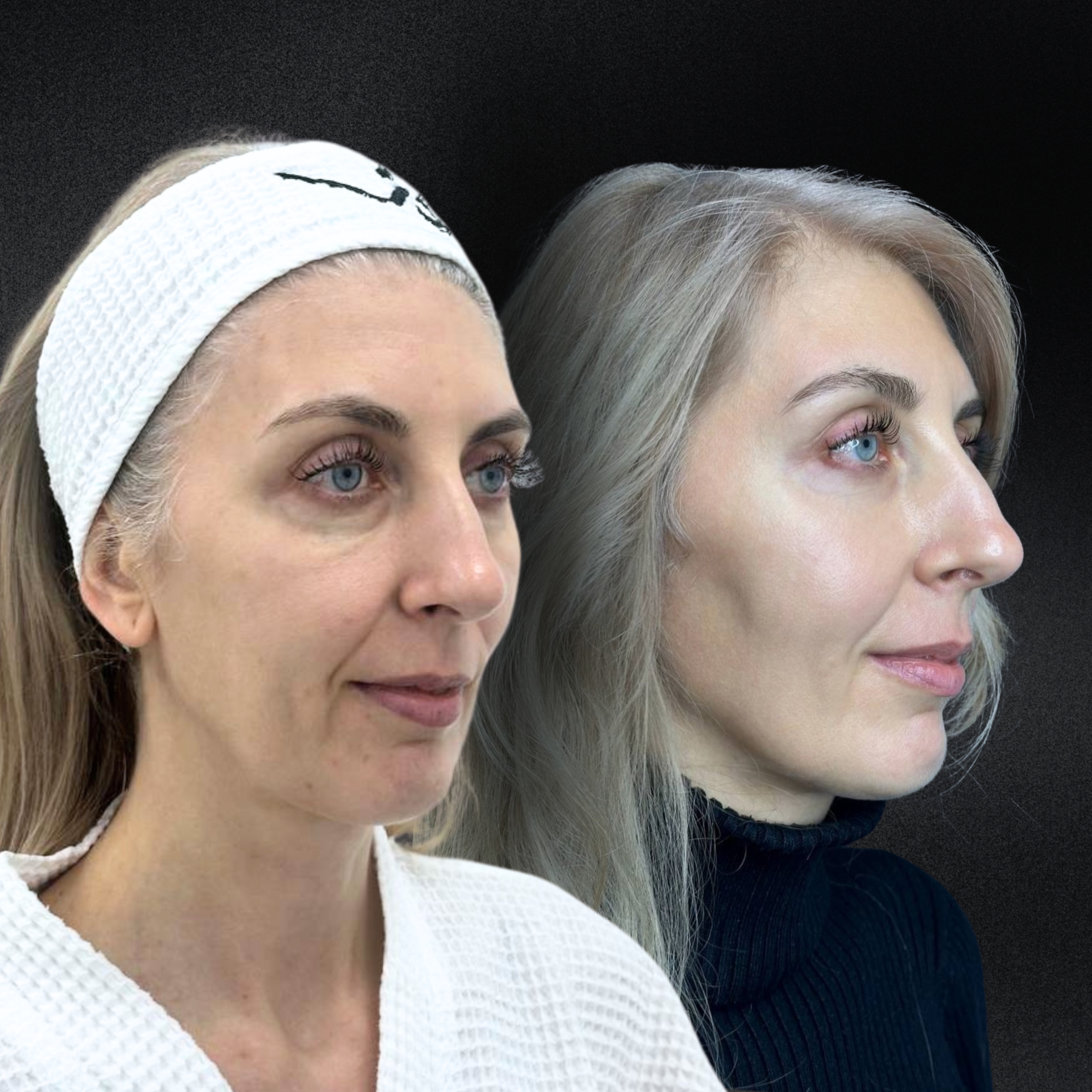 Омоложение кожи и лечение рубцов ALMA HYBRID 01