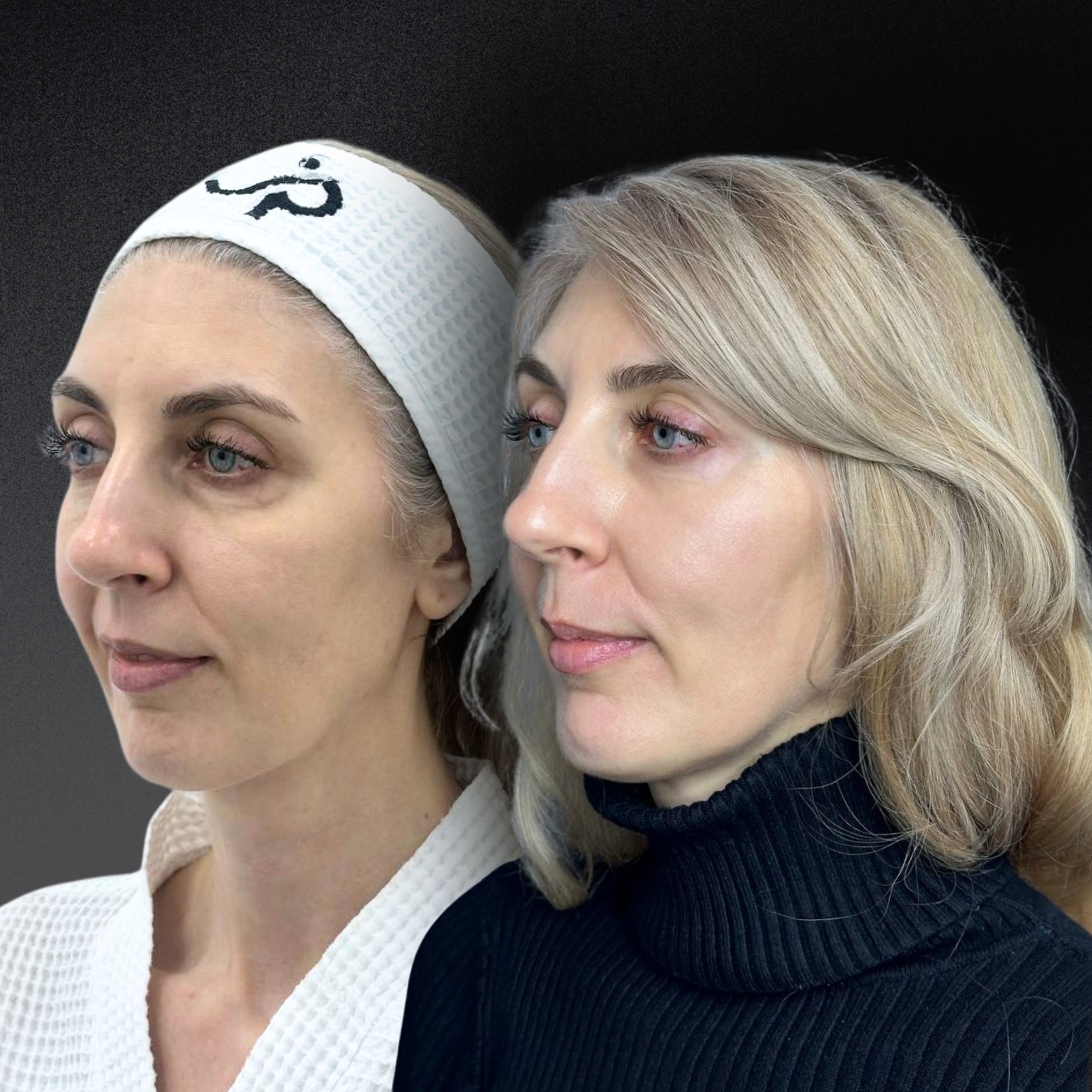 Омоложение кожи и лечение рубцов ALMA HYBRID 01