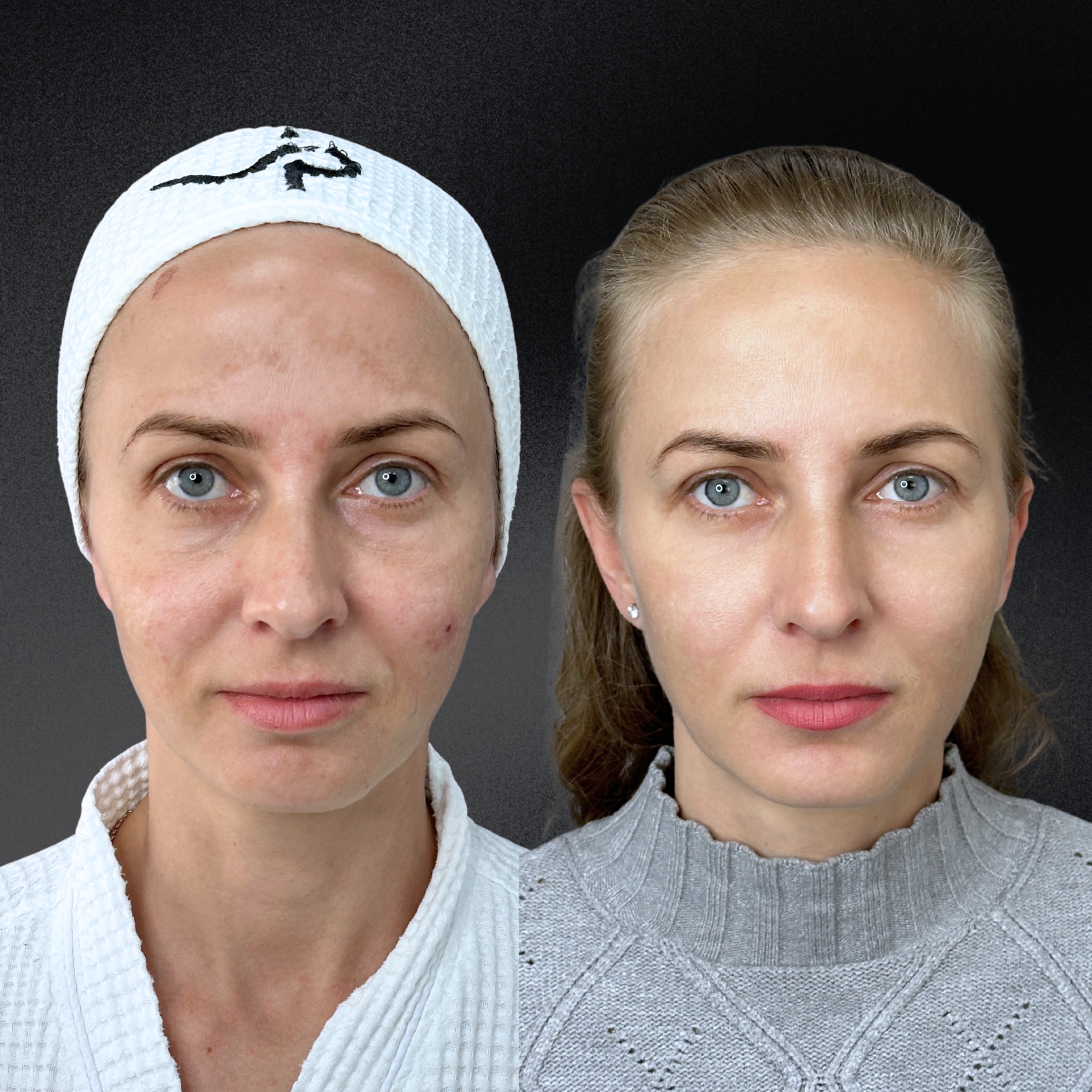 Омоложение кожи и лечение рубцов ALMA HYBRID 01