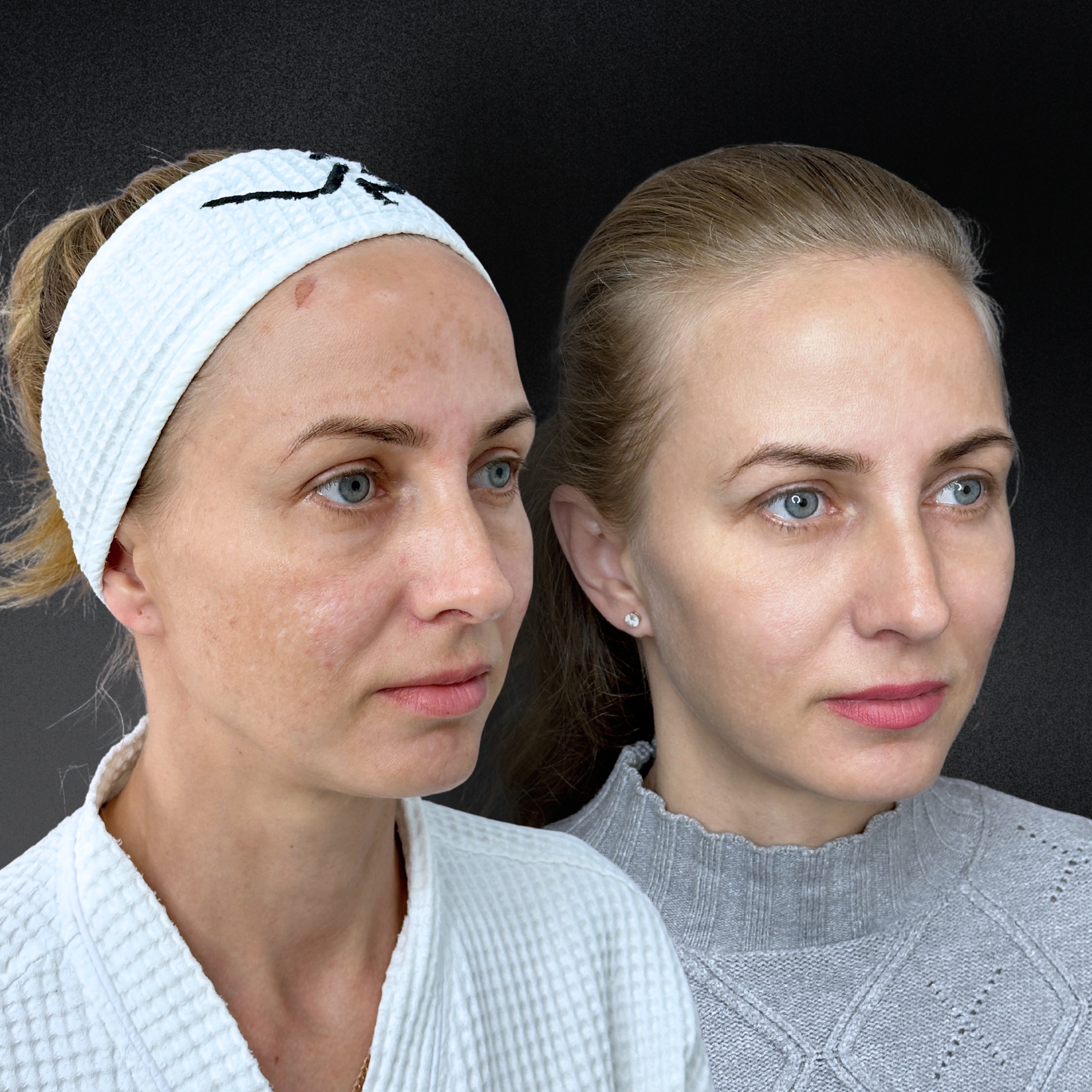 Омоложение кожи и лечение рубцов ALMA HYBRID 01