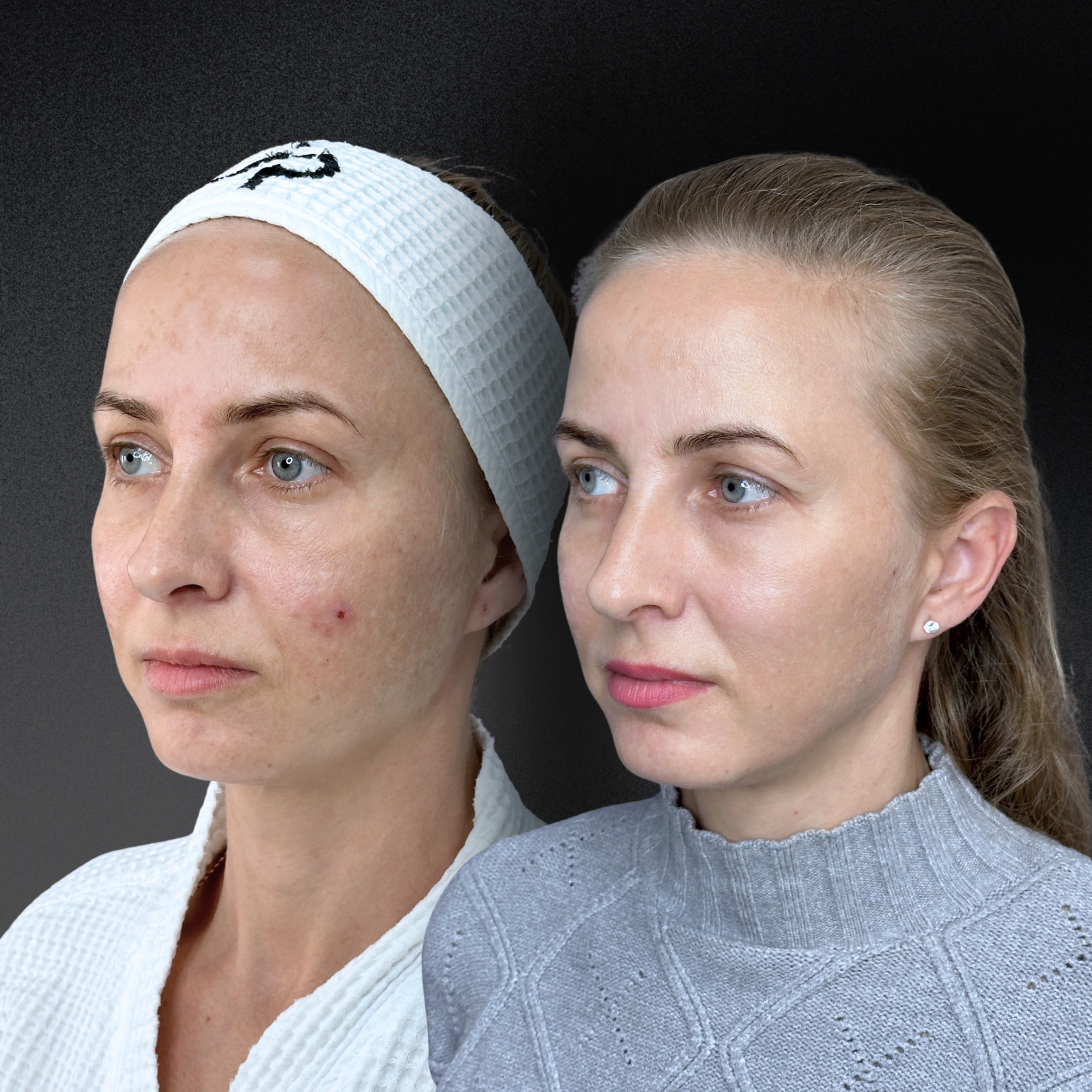 Омоложение кожи и лечение рубцов ALMA HYBRID 01