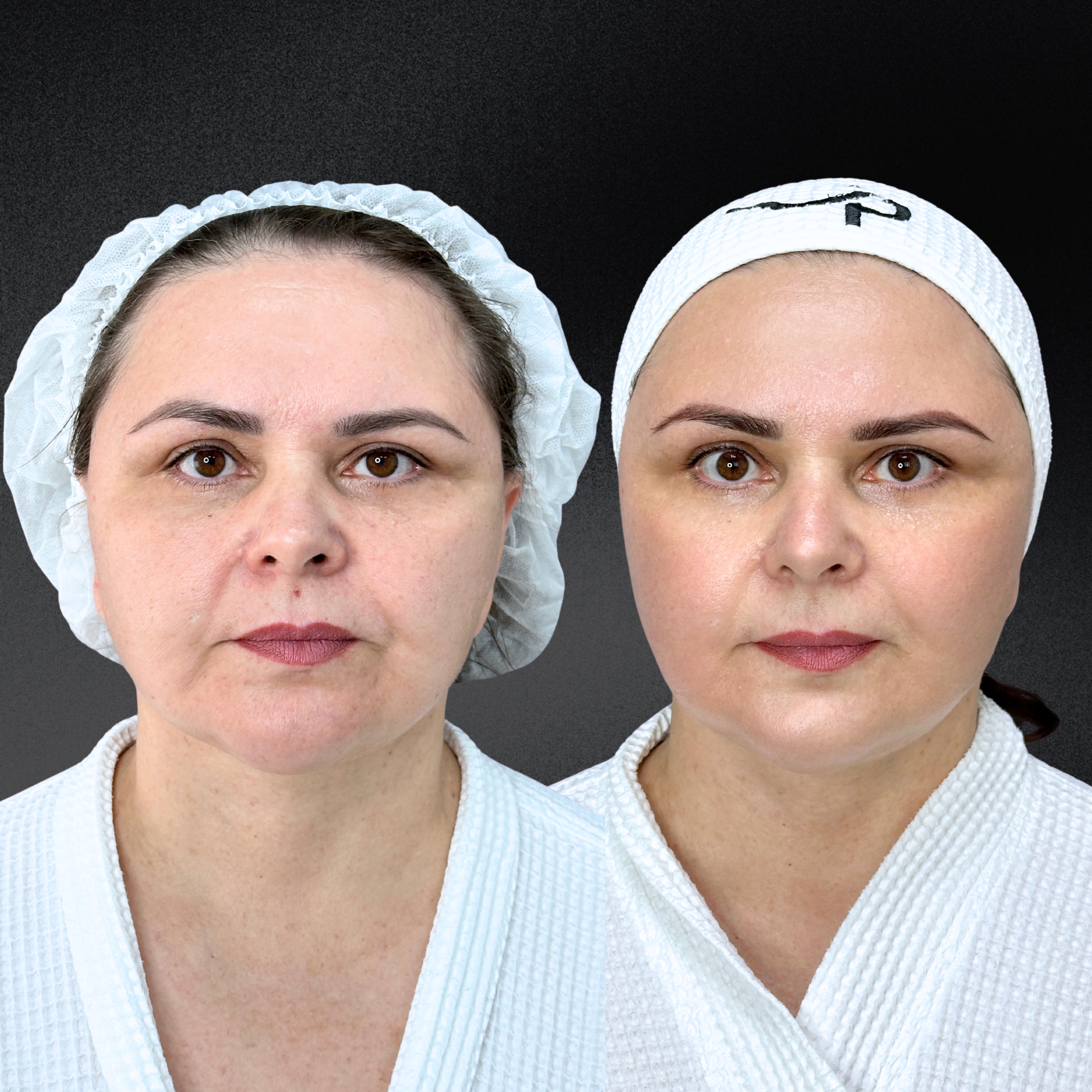 Омоложение кожи и лечение рубцов ALMA HYBRID 01