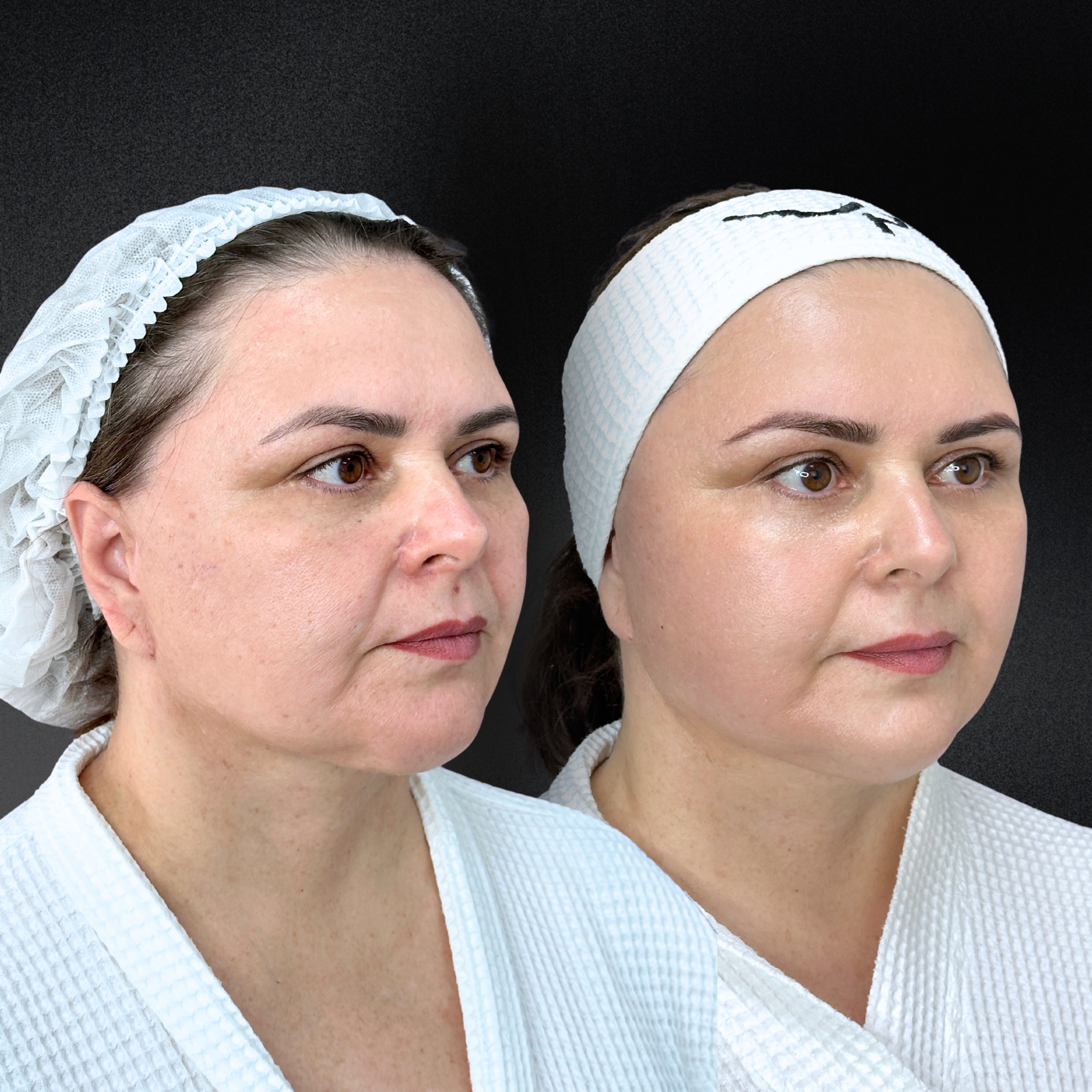 Омоложение кожи и лечение рубцов ALMA HYBRID 01