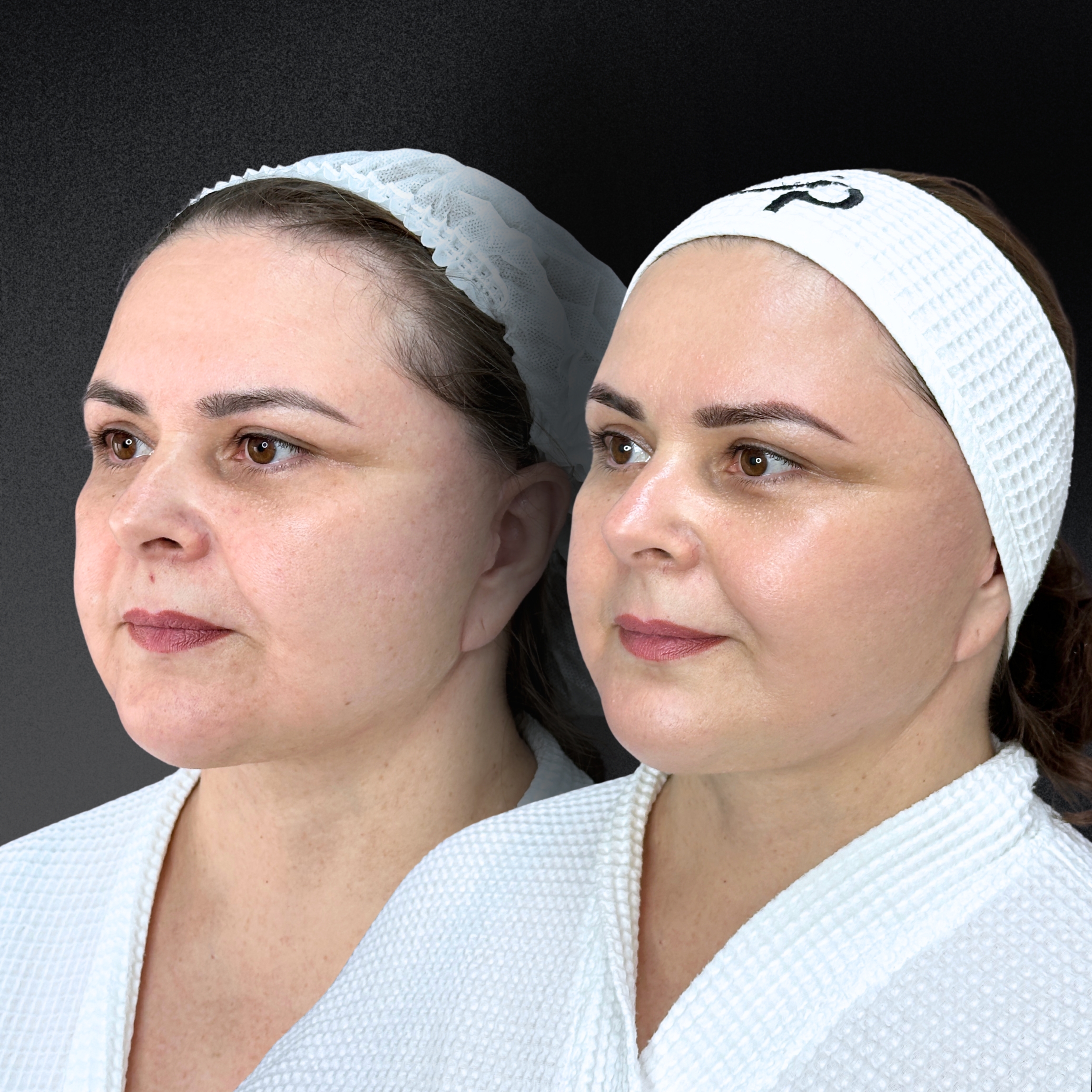 Омоложение кожи и лечение рубцов ALMA HYBRID 01