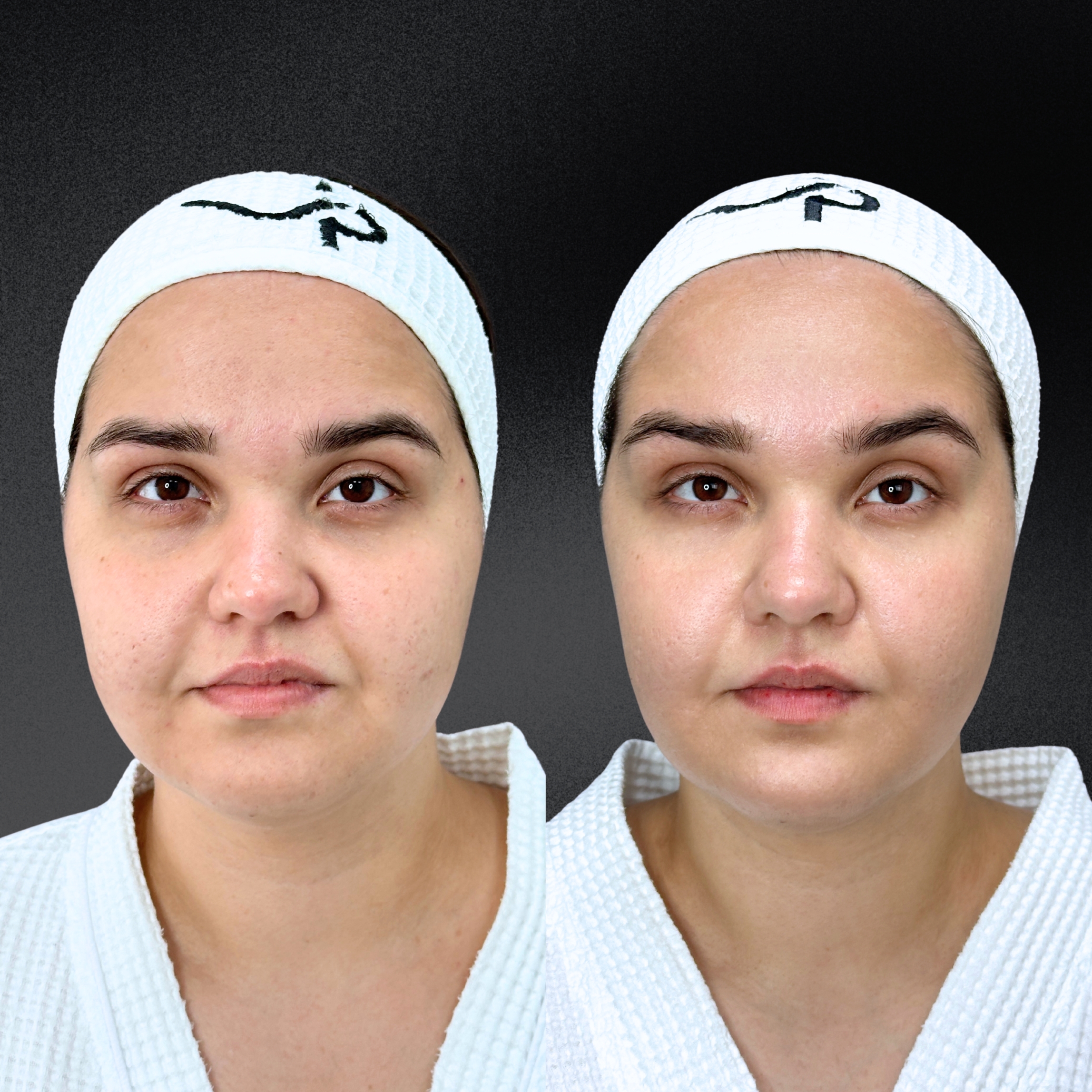 Омоложение кожи и лечение рубцов ALMA HYBRID 01