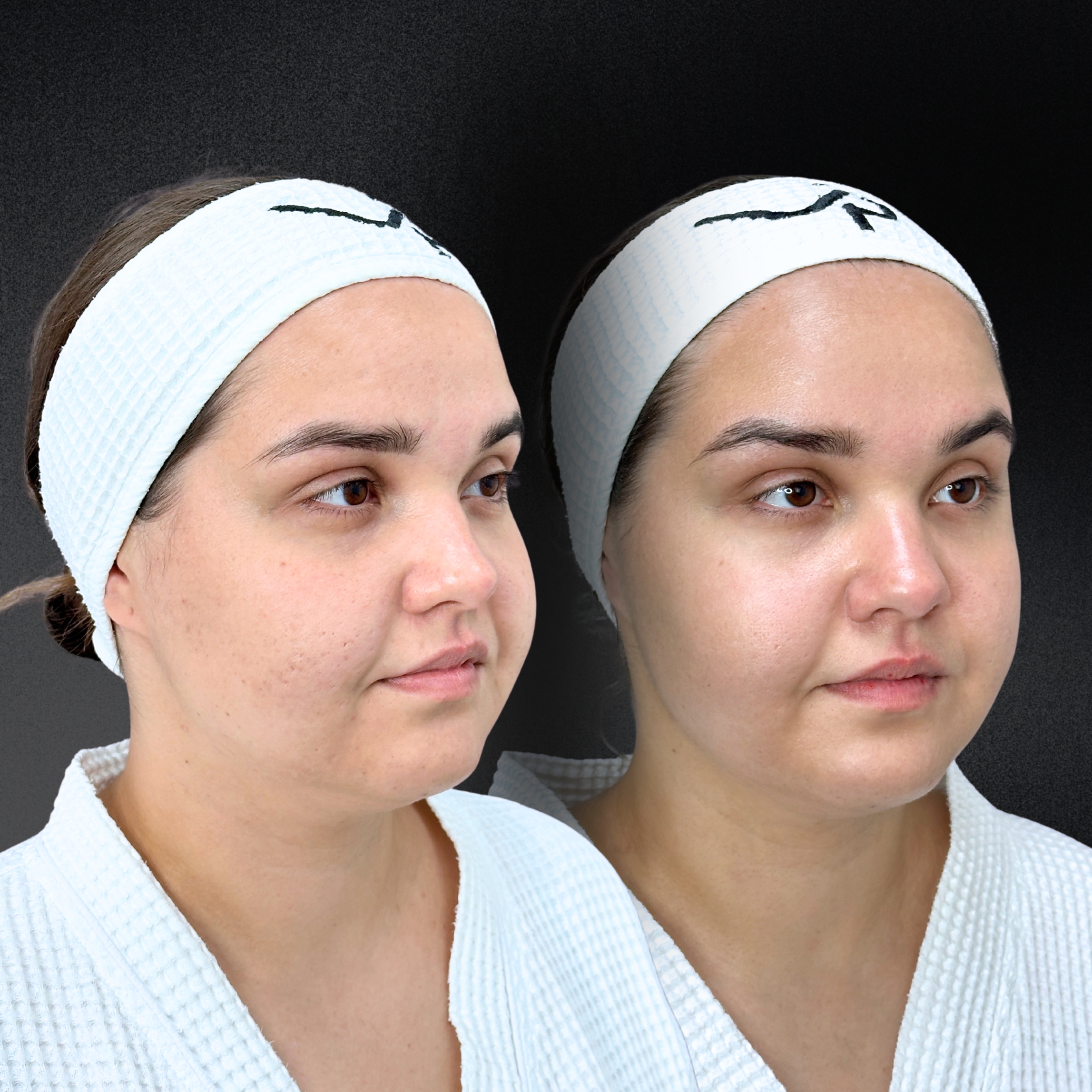 Омоложение кожи и лечение рубцов ALMA HYBRID 01