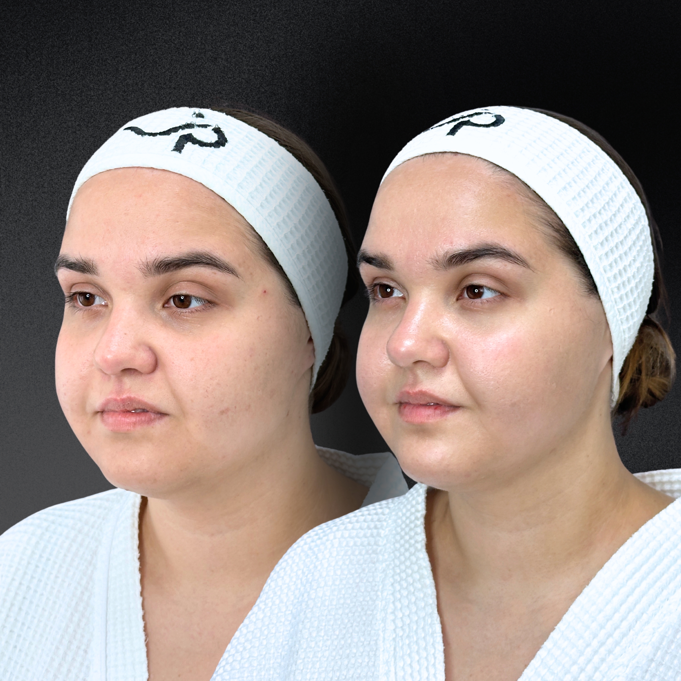 Омоложение кожи и лечение рубцов ALMA HYBRID 01