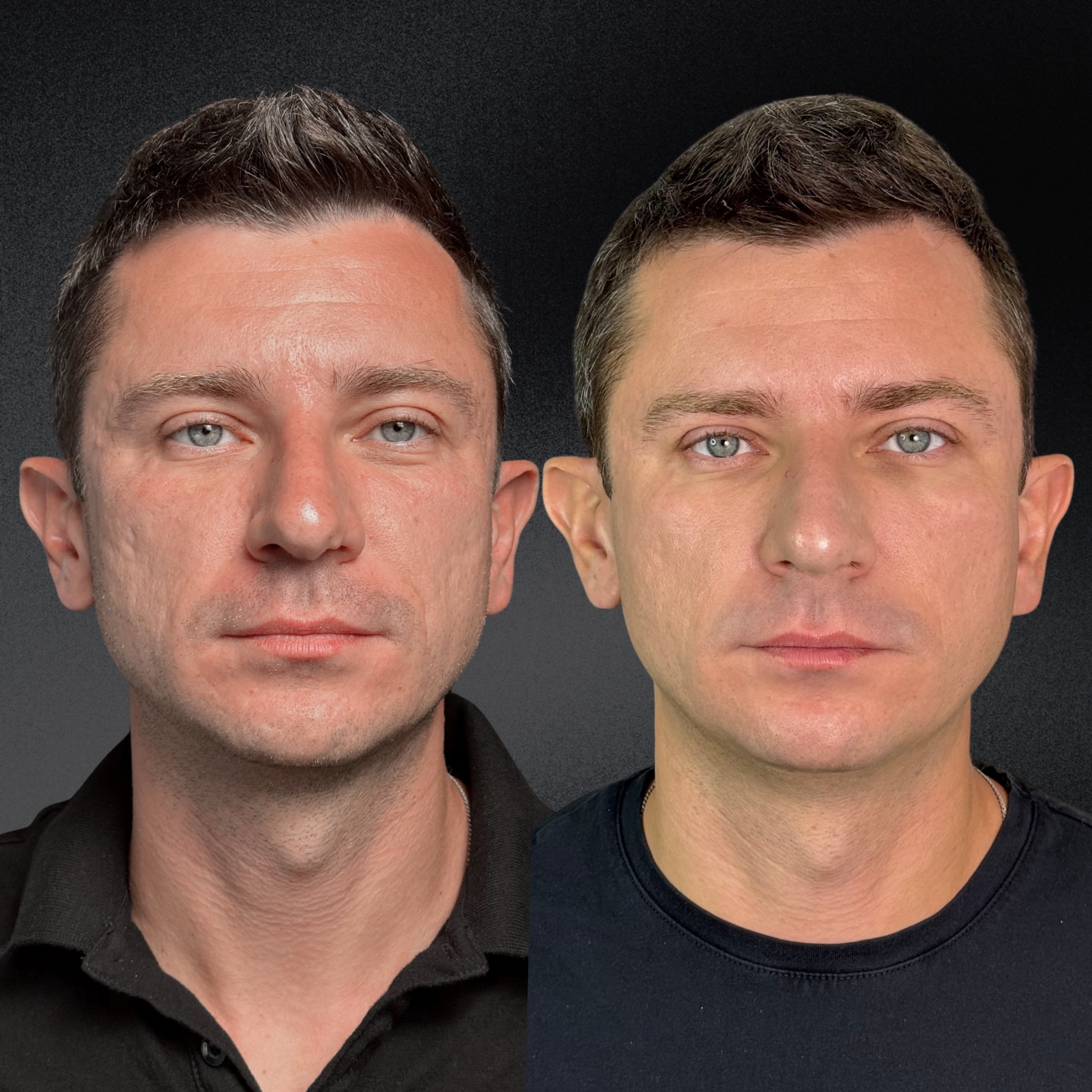 Омоложение кожи и лечение рубцов ALMA HYBRID 01