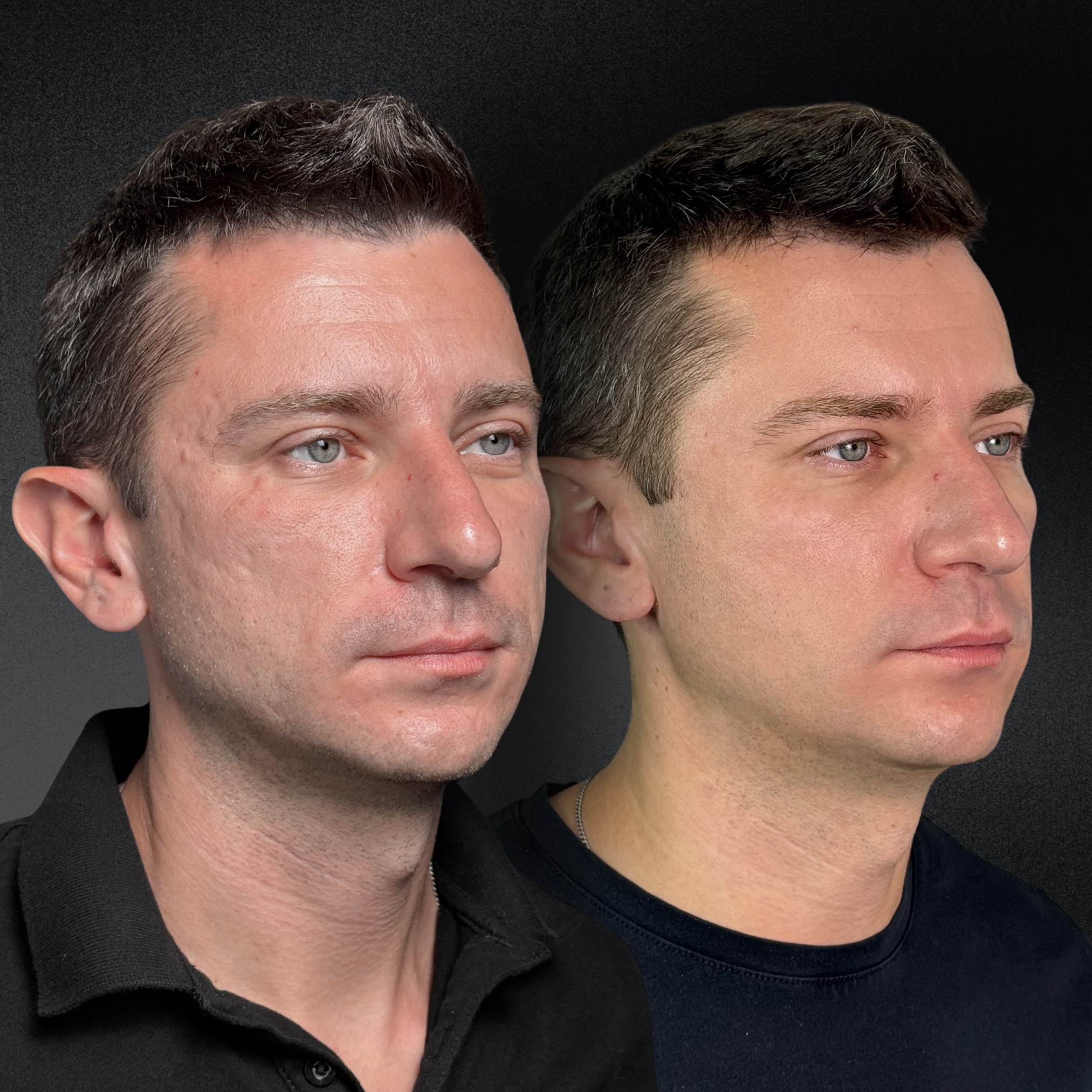 Омоложение кожи и лечение рубцов ALMA HYBRID 01