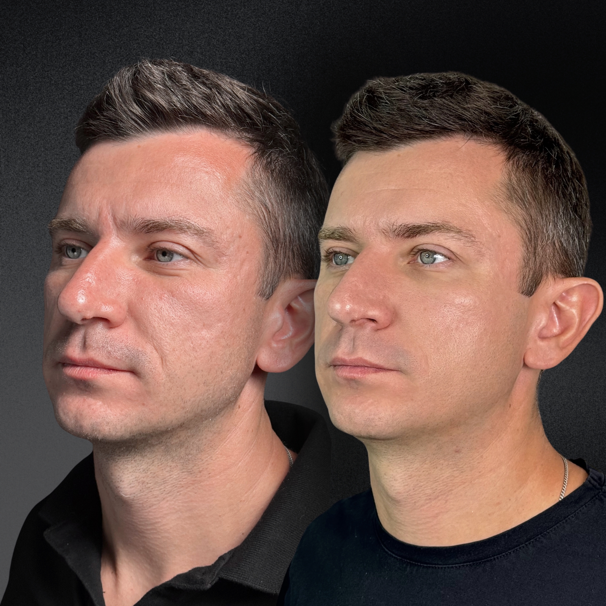 Омоложение кожи и лечение рубцов ALMA HYBRID 01