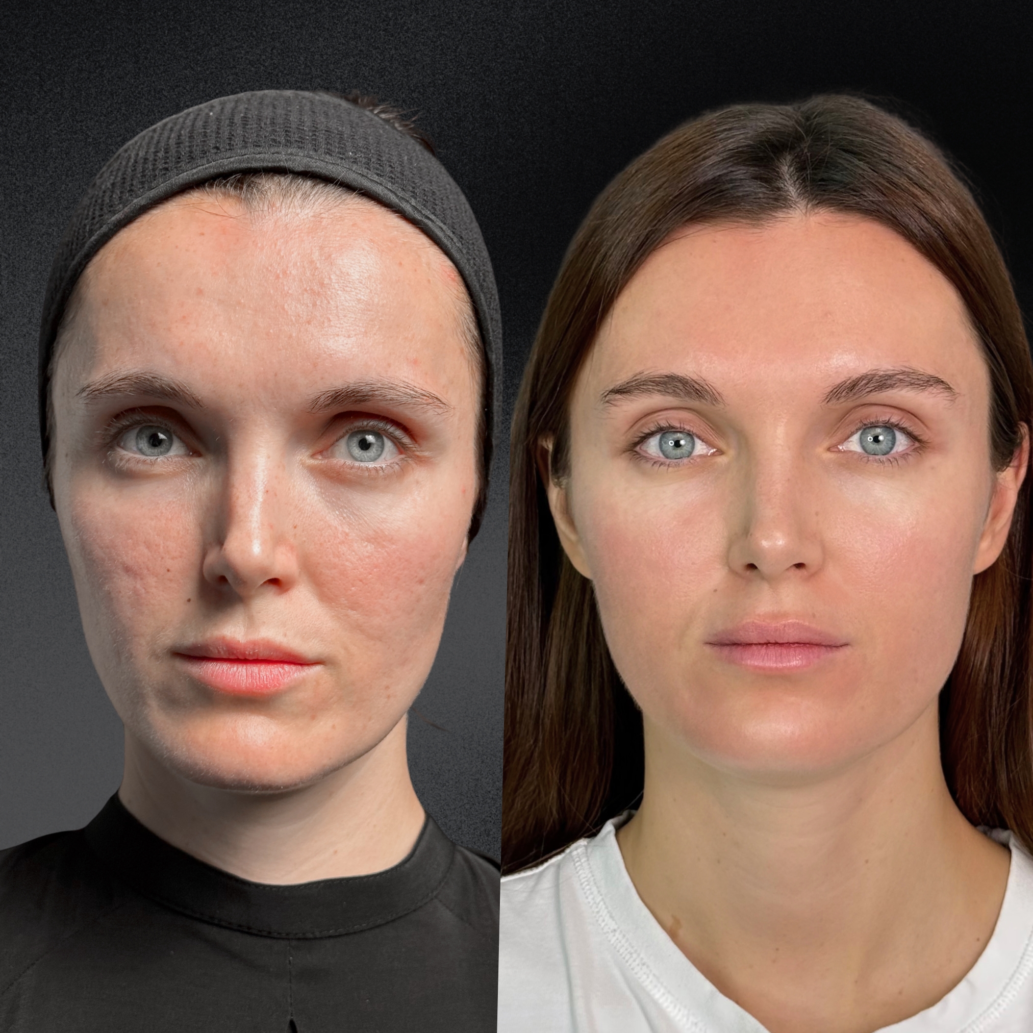 Омоложение кожи и лечение рубцов ALMA HYBRID 01