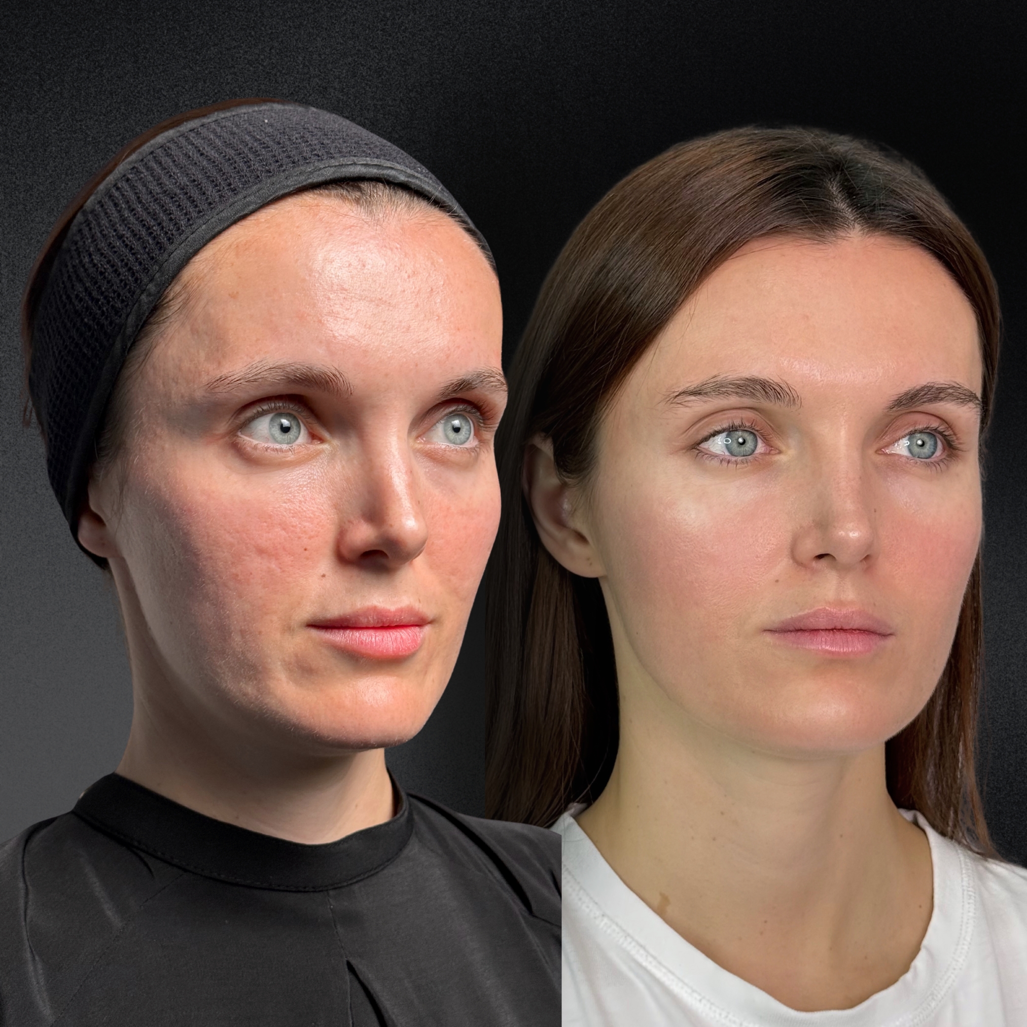 Омоложение кожи и лечение рубцов ALMA HYBRID 01