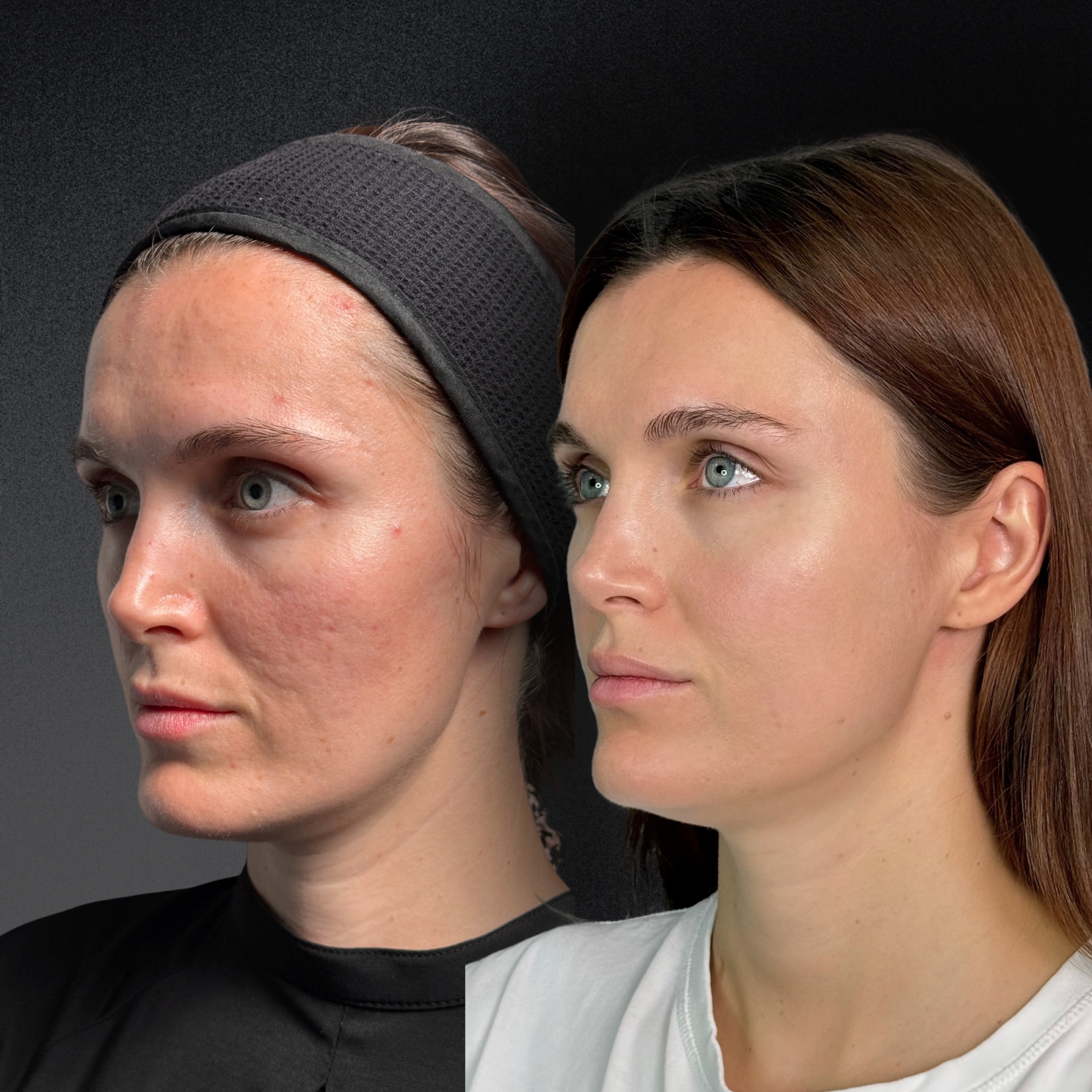 Омоложение кожи и лечение рубцов ALMA HYBRID 01