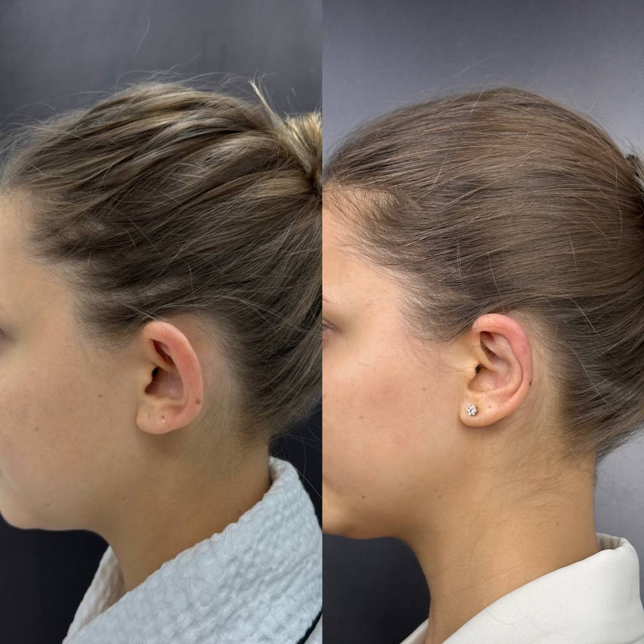 Выпуск 12 - Милые ушки или ненавистные уши? История пациента Елены 05