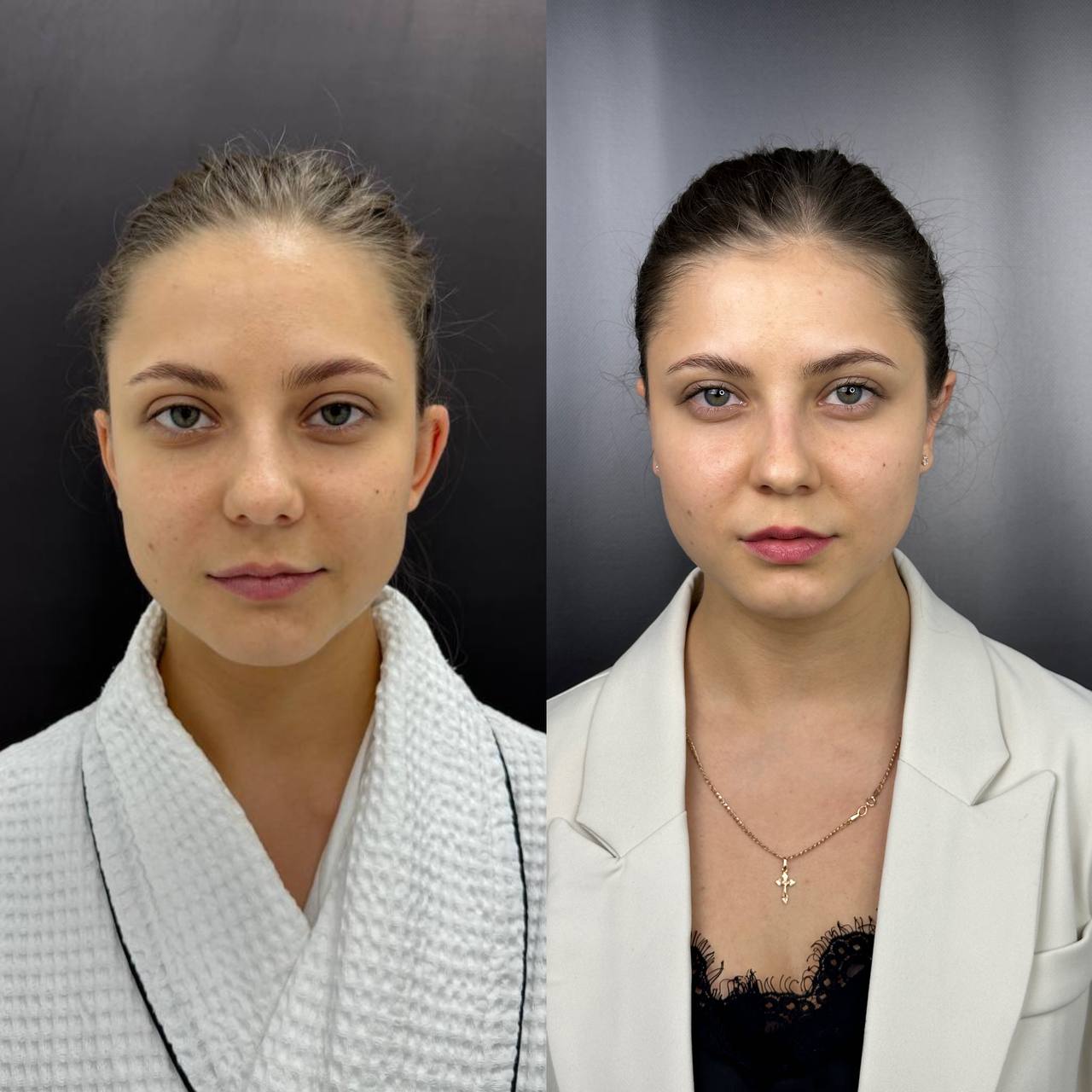 Выпуск 12 - Милые ушки или ненавистные уши? История пациента Елены 04