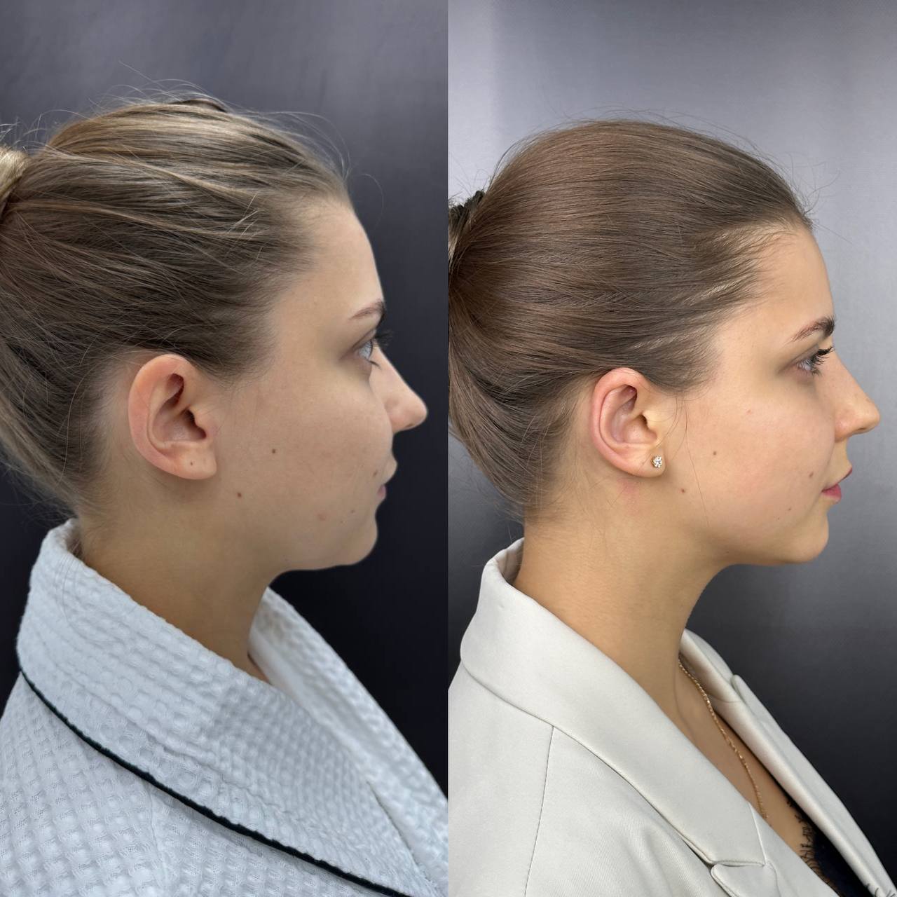 Выпуск 12 - Милые ушки или ненавистные уши? История пациента Елены 03