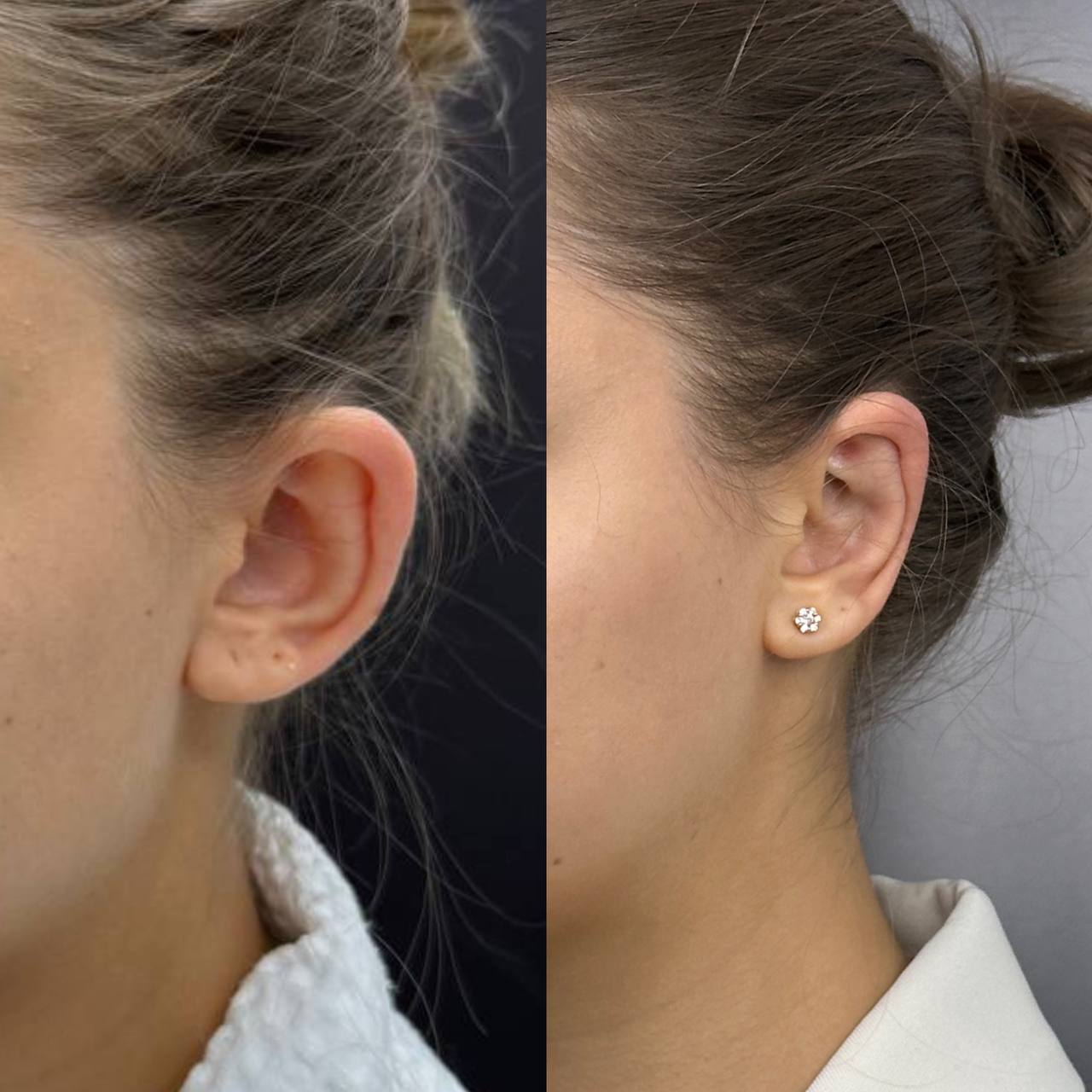 Выпуск 12 - Милые ушки или ненавистные уши? История пациента Елены 02