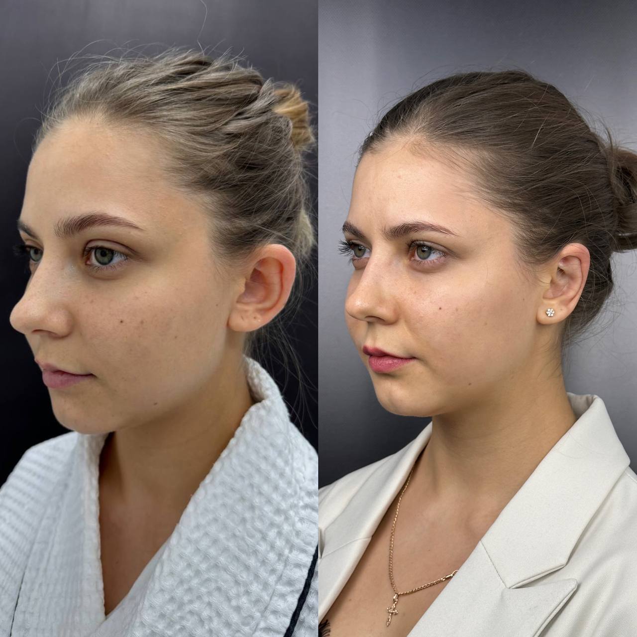 Выпуск 12 - Милые ушки или ненавистные уши? История пациента Елены 01