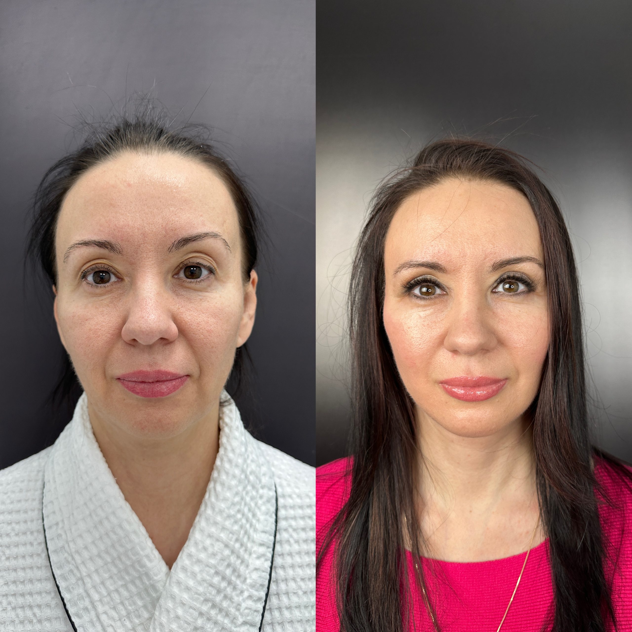 Выпуск 11 - Год сомнений и одно верное решение: SMAS-лифтинг. История пациента Натальи 07