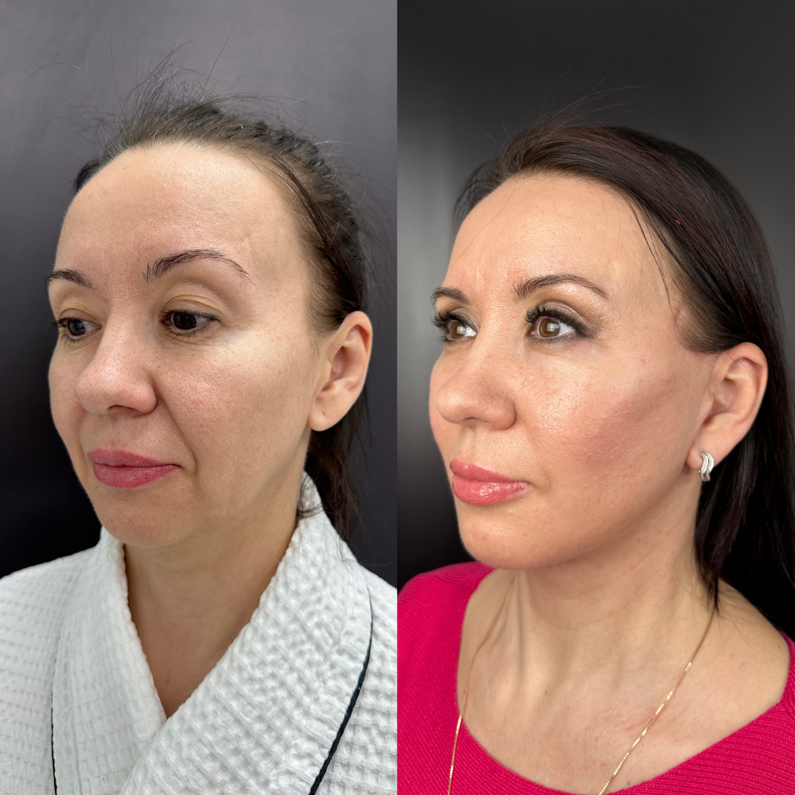 Выпуск 11 - Год сомнений и одно верное решение: SMAS-лифтинг. История пациента Натальи 06