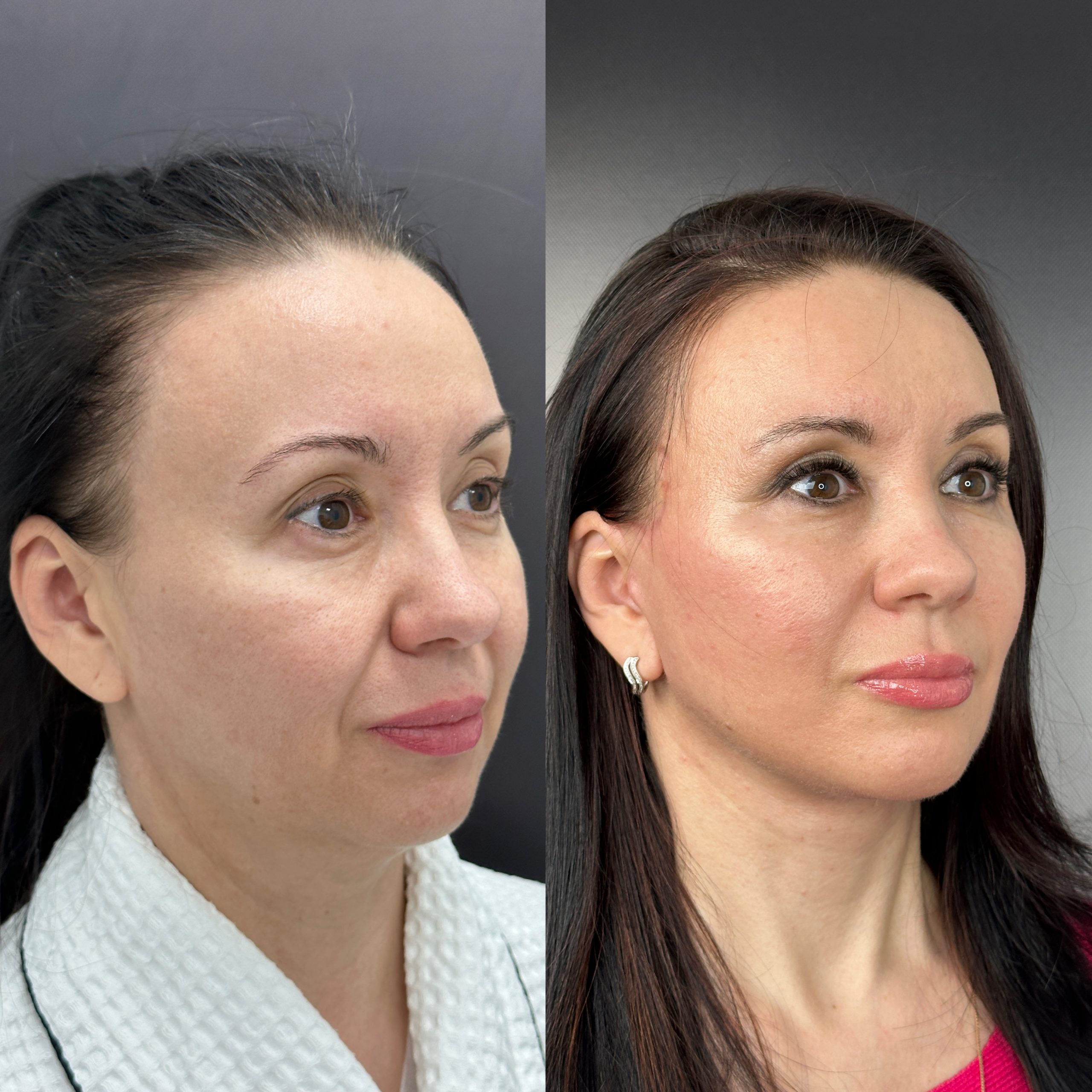 Выпуск 11 - Год сомнений и одно верное решение: SMAS-лифтинг. История пациента Натальи 05