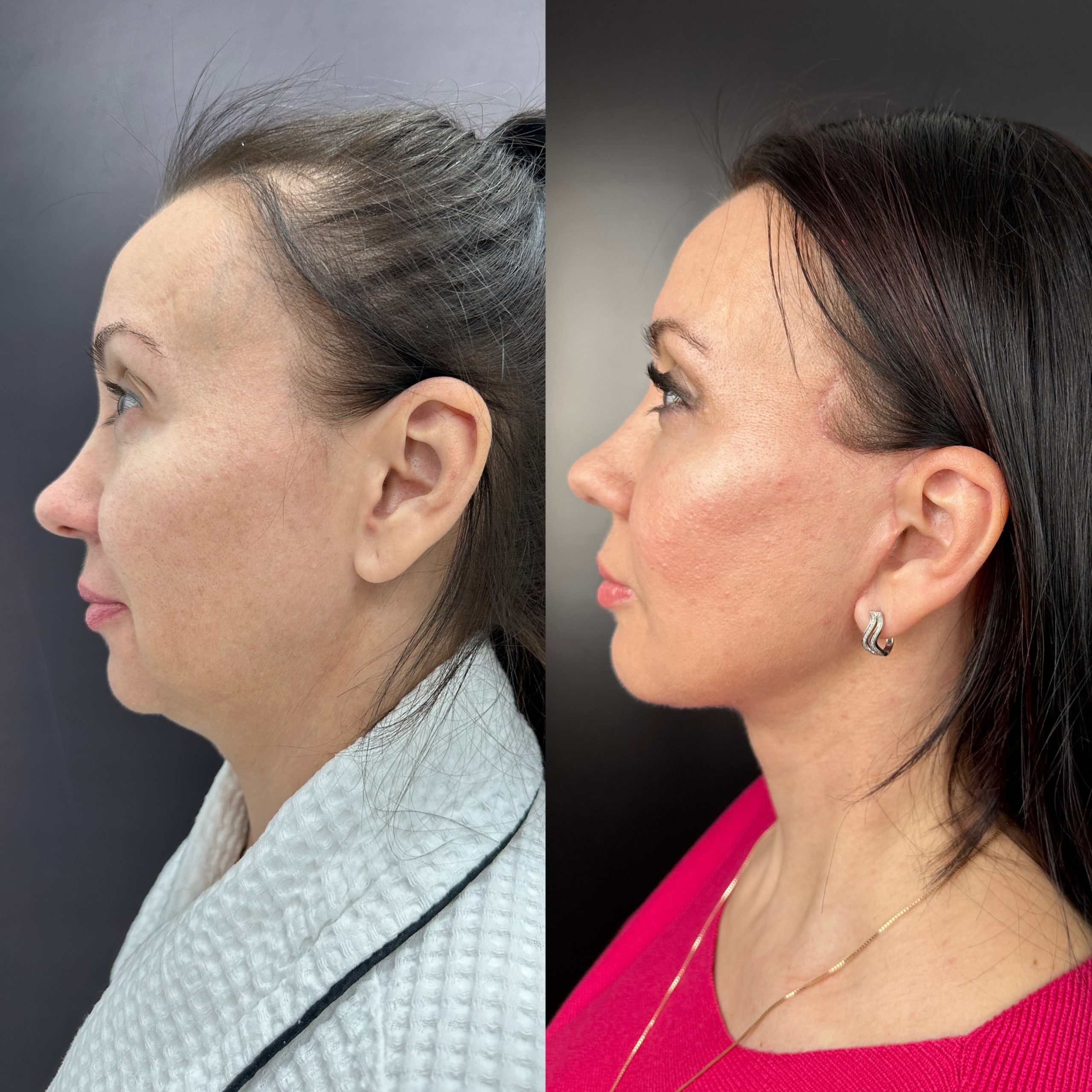 Выпуск 11 - Год сомнений и одно верное решение: SMAS-лифтинг. История пациента Натальи 03