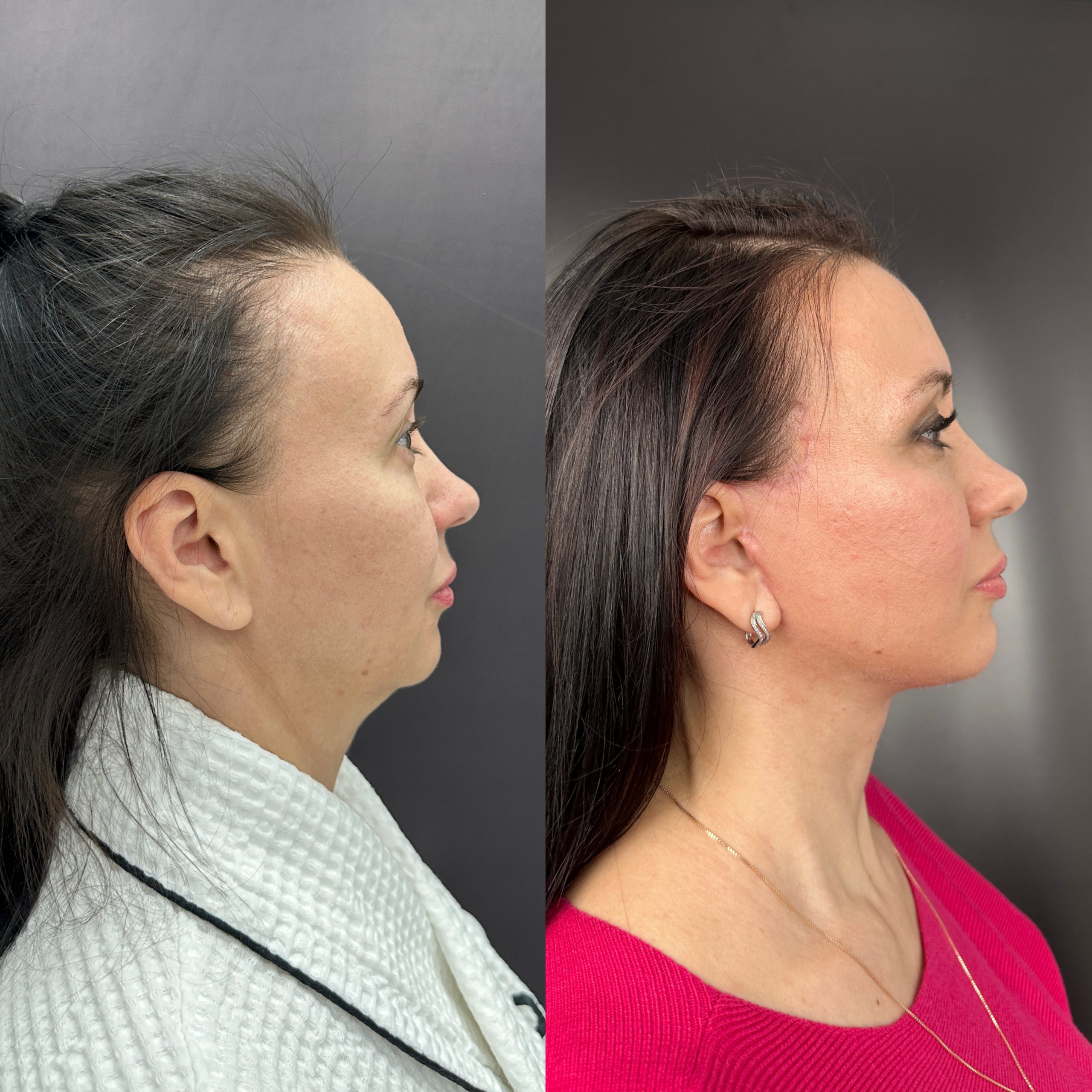 Выпуск 11 - Год сомнений и одно верное решение: SMAS-лифтинг. История пациента Натальи 02