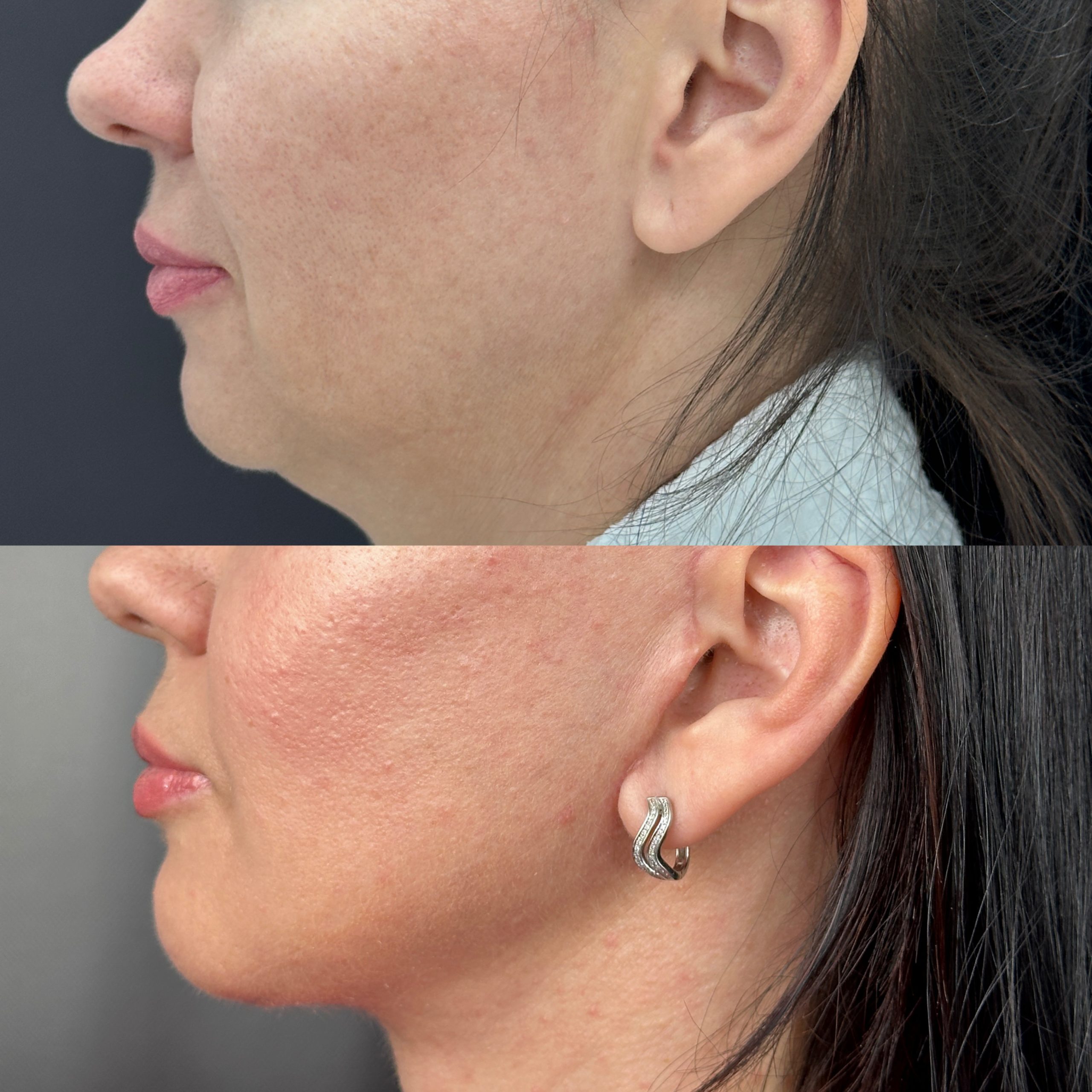 Выпуск 11 - Год сомнений и одно верное решение: SMAS-лифтинг. История пациента Натальи 01