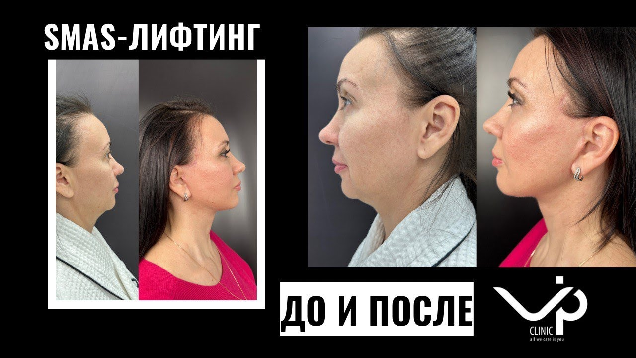 Выпуск 11 — Год сомнений и одно верное решение: SMAS-лифтинг. История пациента Натальи