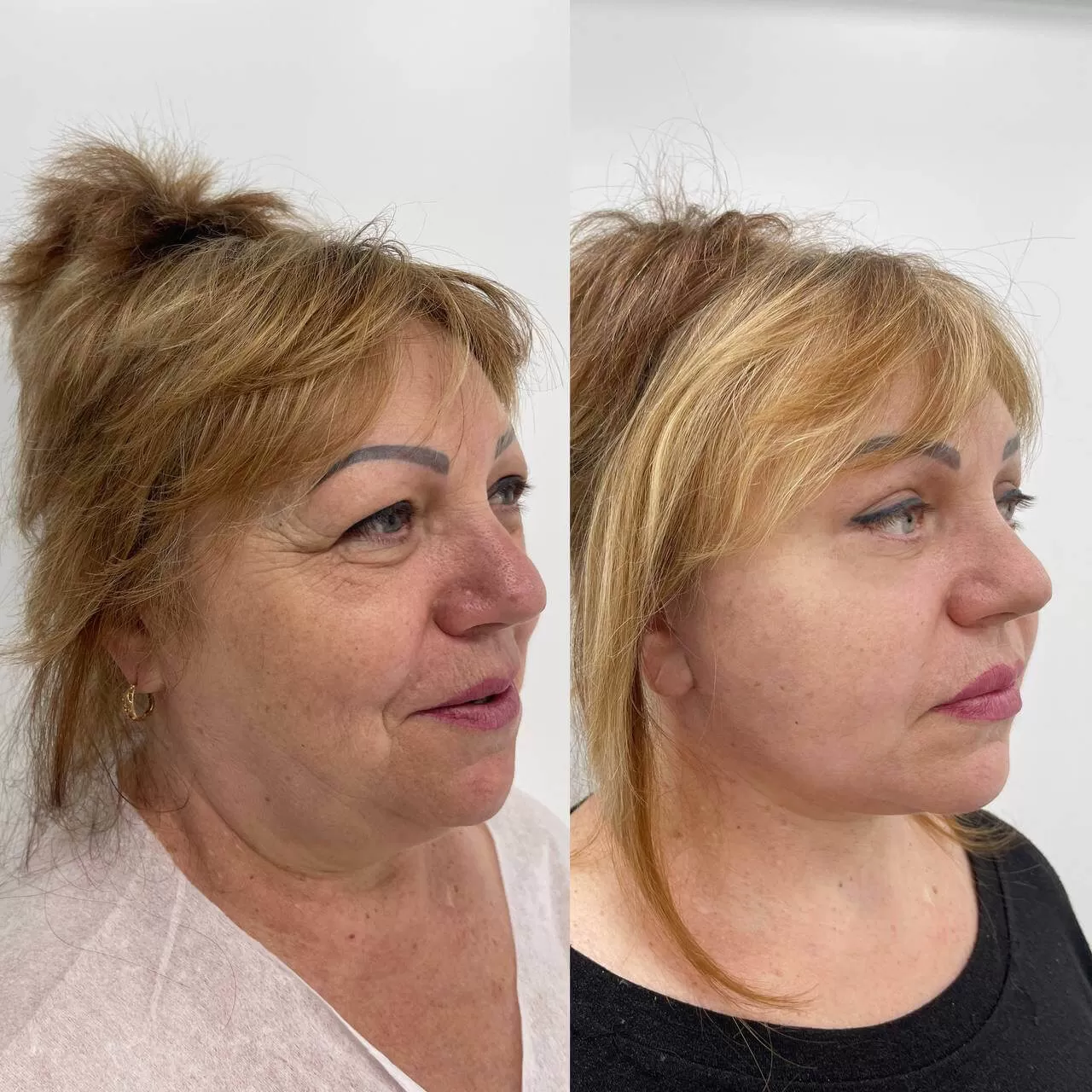 Выпуск 16 - SMAS-лифтинг. История пациента Елены 01