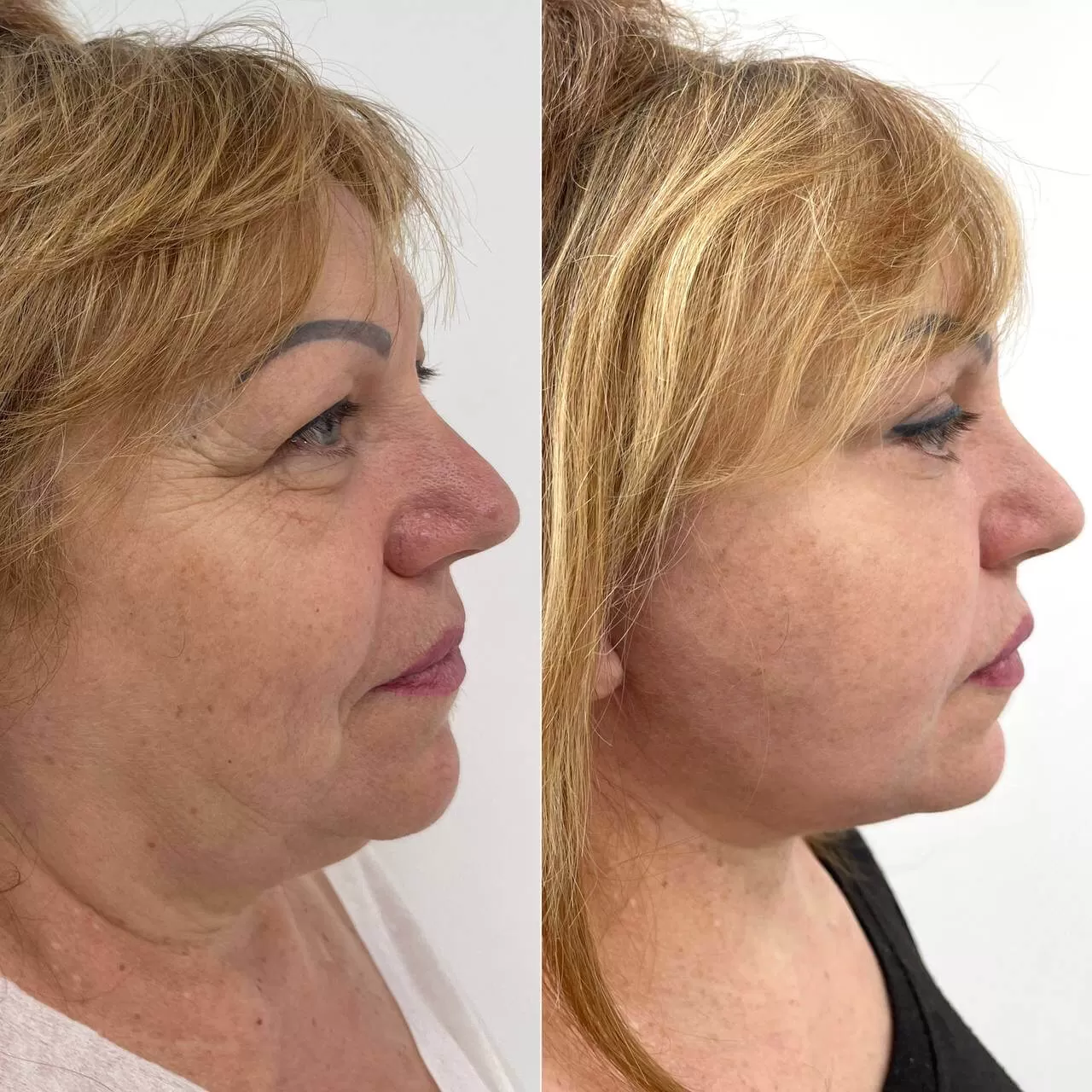 Выпуск 16 - SMAS-лифтинг. История пациента Елены 02