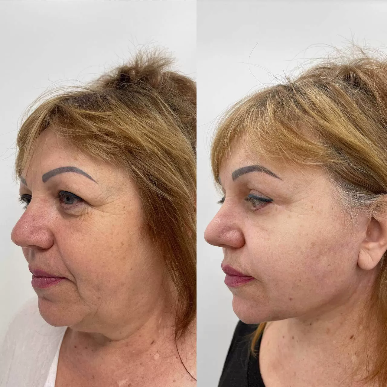 Выпуск 16 - SMAS-лифтинг. История пациента Елены 03