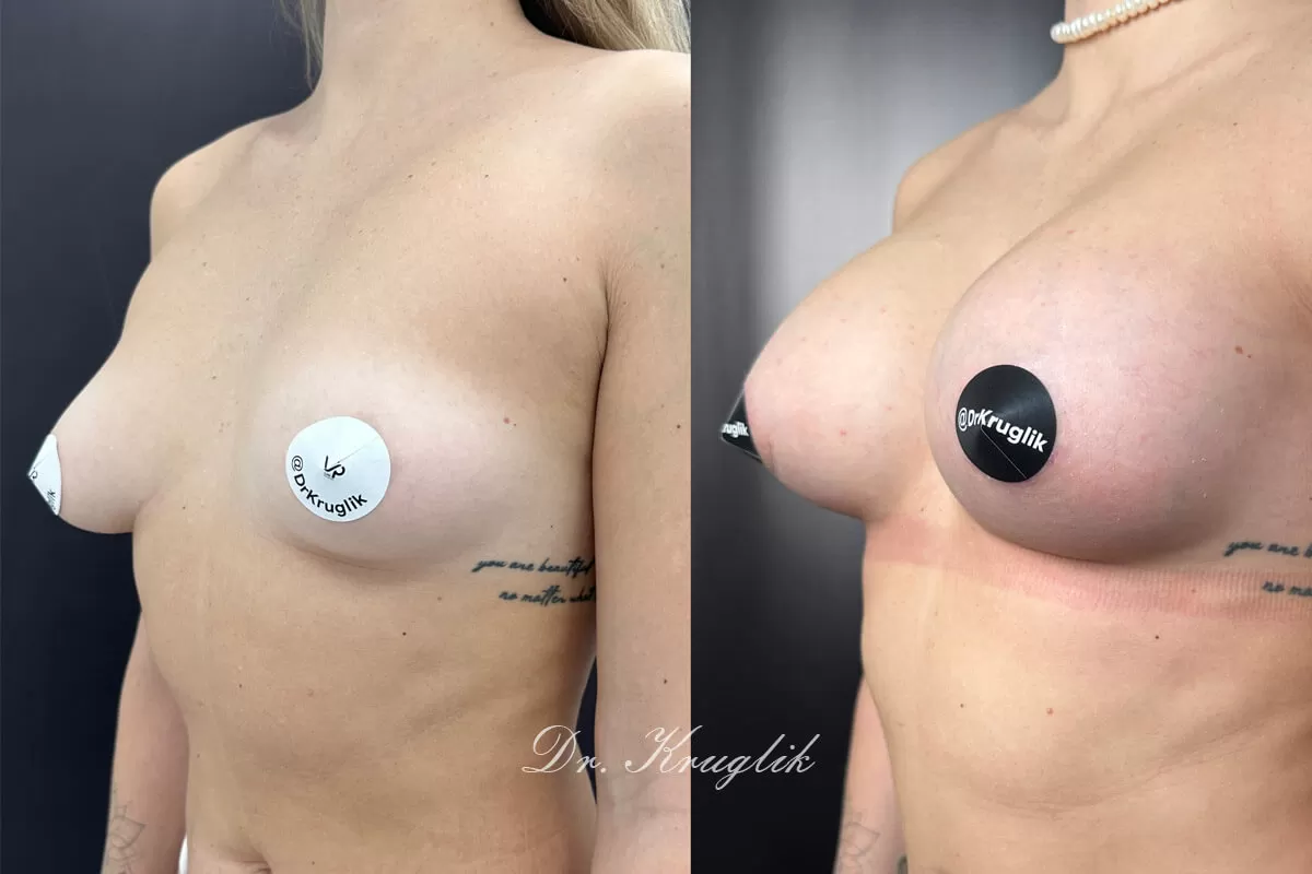 Выпуск 13 - «Я теперь с особенным нетерпением жду отпуска и возможности надеть купальник». История пациента Виктории 03