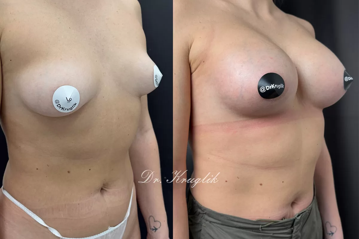 Выпуск 13 - «Я теперь с особенным нетерпением жду отпуска и возможности надеть купальник». История пациента Виктории 02