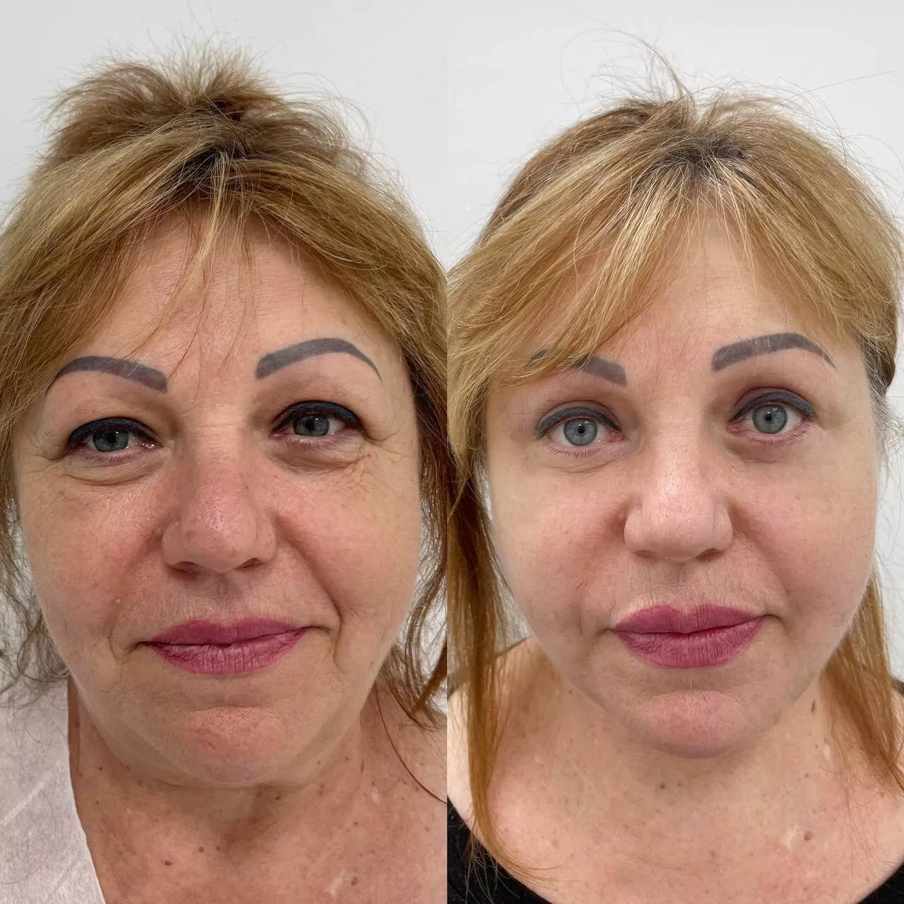 Выпуск 16 - SMAS-лифтинг. История пациента Елены 04