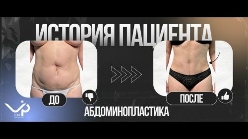 Выпуск 17 — «Если это принесет радость — значит надо делать» История пациента Елены