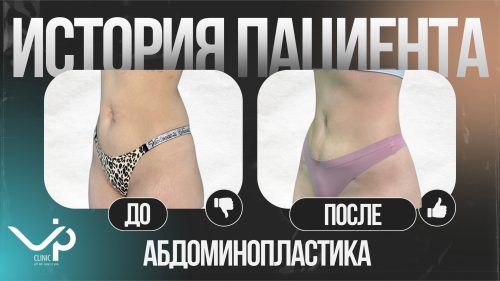 Выпуск 18 — «Я себя ощущаю так, как никогда не ощущала» История пациента Айсель