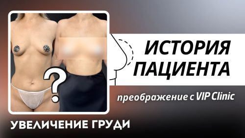 Выпуск 21 — «Мне нравится моя грудь, нравится ее трогать» История пациента Виктории
